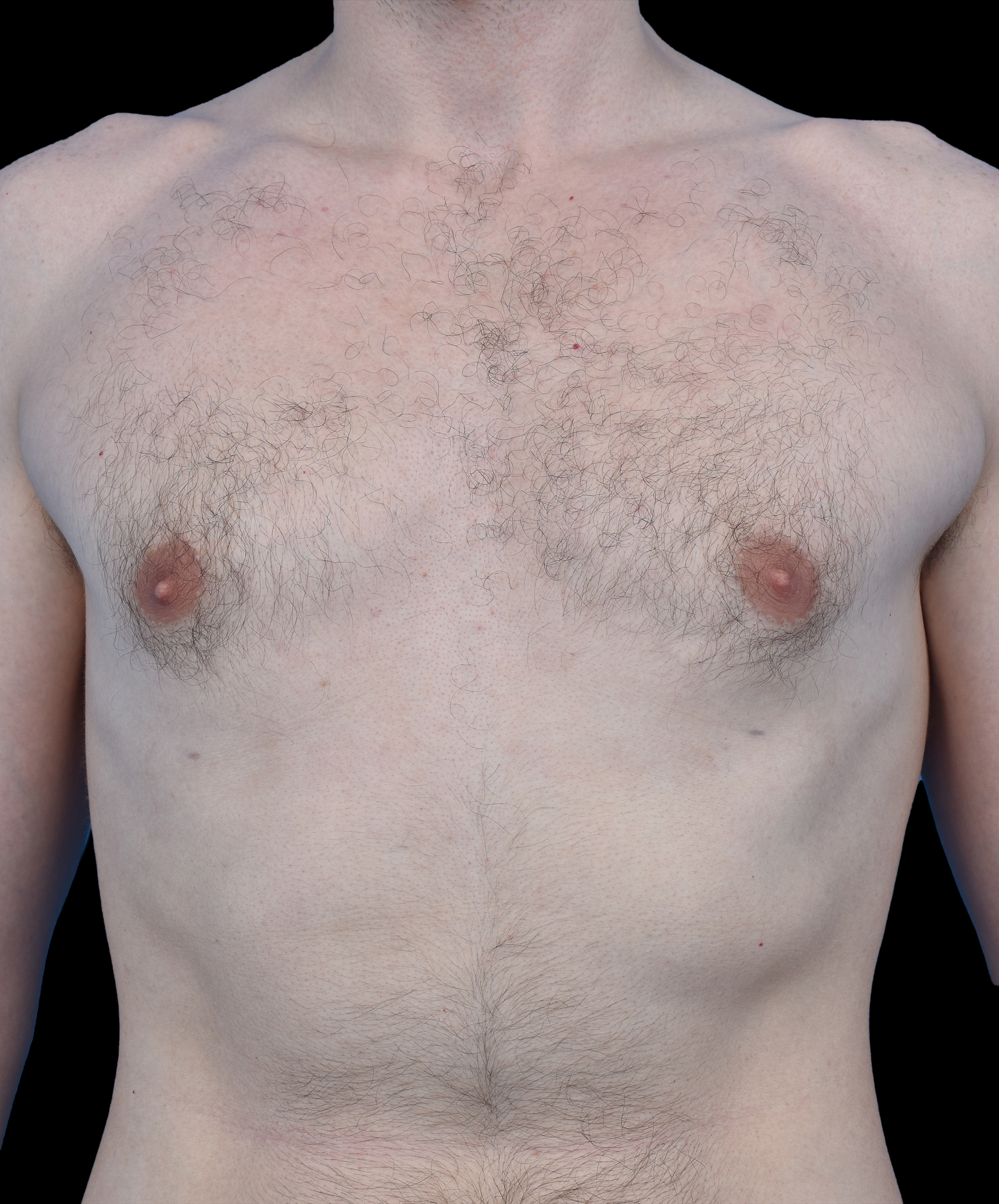 Ginekomastia liposukcja i wycięcie Wrocław dr Kołacz – męska klatka piersiowa po zabiegu