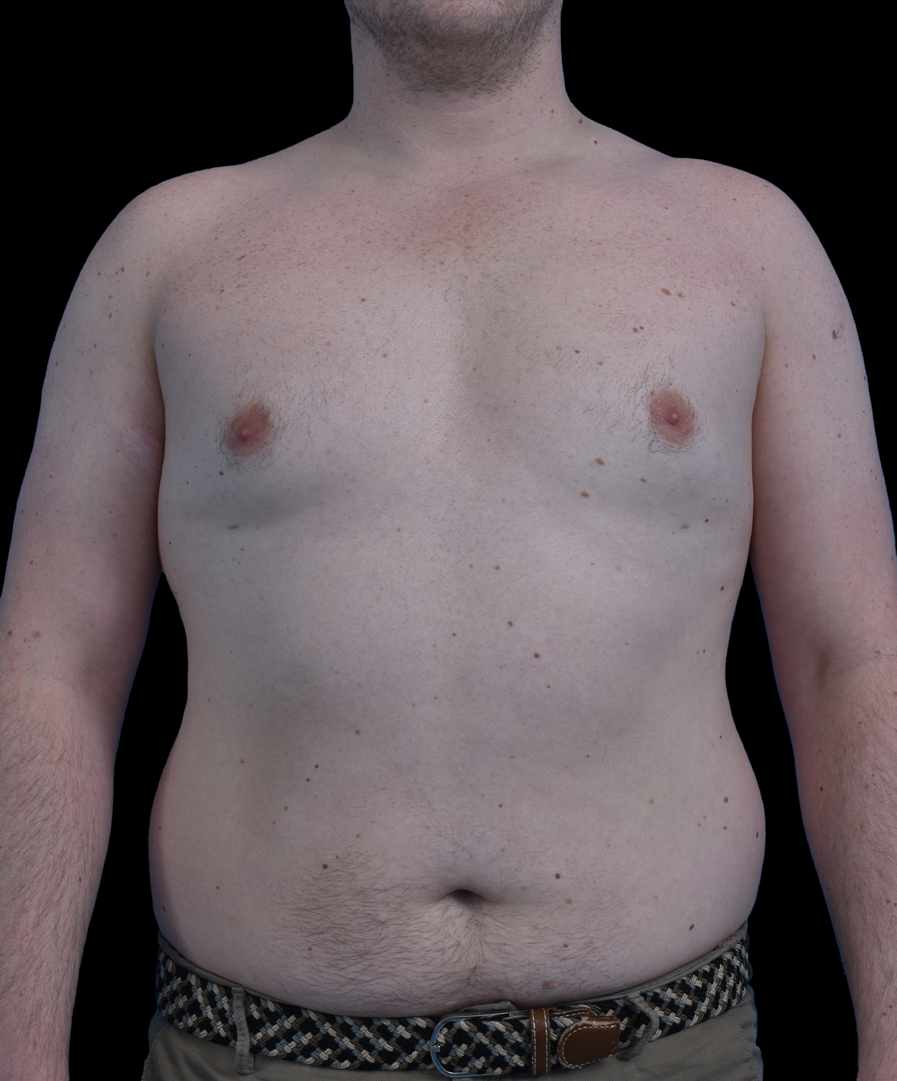 Ginekomastia liposukcja Wrocław dr Kołacz – efekt po odessaniu tłuszczu z klatki piersiowej