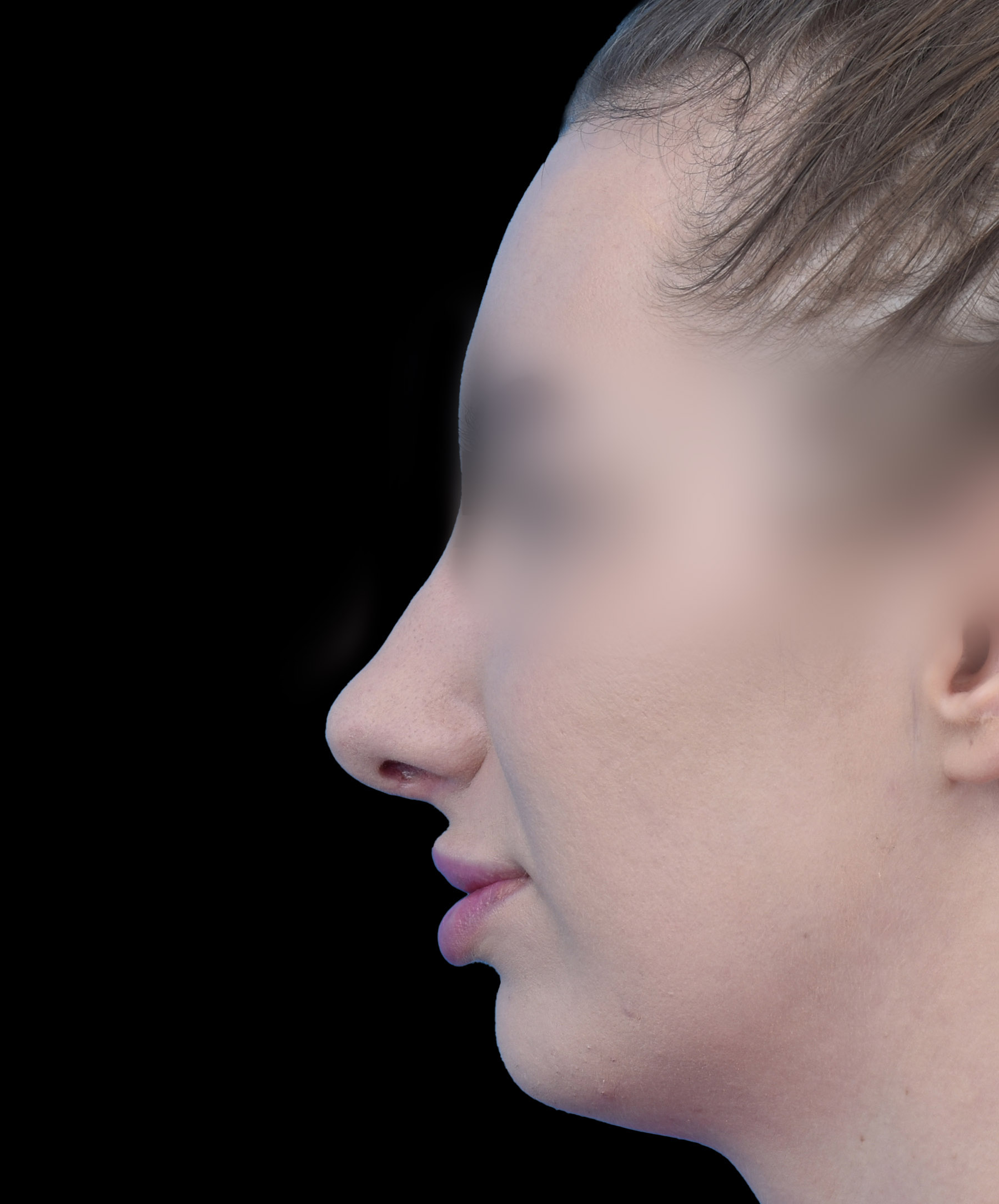 Zdjęcie przedstawia porównanie przed i po operacji korekcji nosa. Po lewej stronie widoczny jest nos pacjenta przed zabiegiem, z widocznymi nierównościami i asymetrią. Po prawej stronie efekt po operacji – nos ma prostszy kształt, jest bardziej symetryczny i harmonijnie dopasowany do rysów twarzy