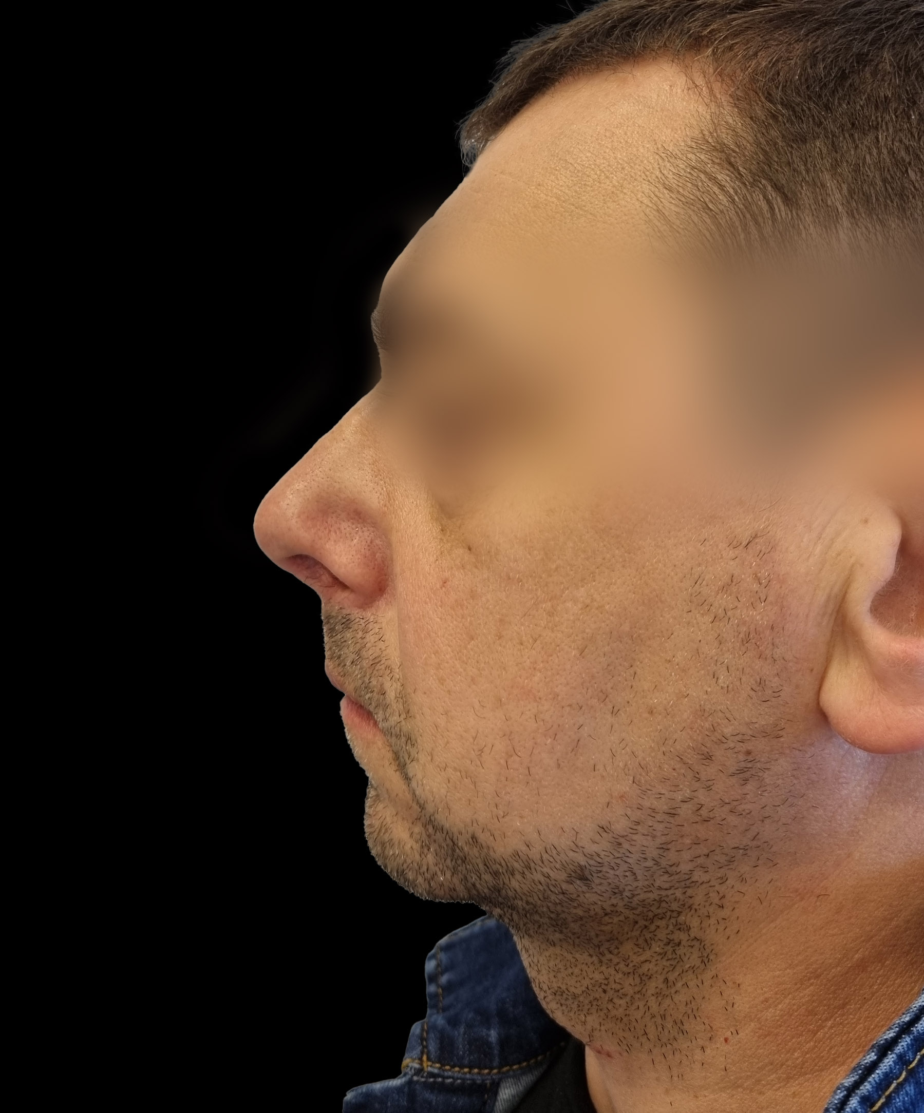 Zdjęcie ukazuje porównanie przed i po operacji korekcji pourazowego zniekształcenia nosa. Przed zabiegiem nos pacjenta wykazuje wyraźne skrzywienie oraz deformacje spowodowane urazem. Po operacji widoczna jest znacząca poprawa – nos jest prosty, symetryczny, a jego kształt został przywrócony do naturalnego wyglądu.