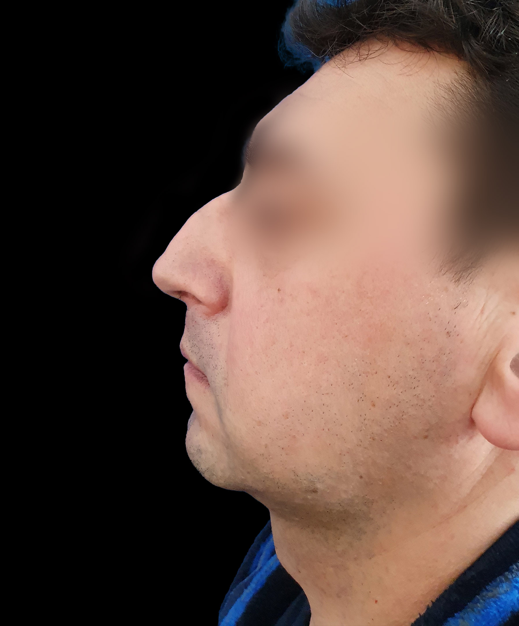 Zdjęcie ukazuje porównanie przed i po operacji korekcji pourazowego zniekształcenia nosa. Przed zabiegiem nos pacjenta wykazuje wyraźne skrzywienie oraz deformacje spowodowane urazem. Po operacji widoczna jest znacząca poprawa – nos jest prosty, symetryczny, a jego kształt został przywrócony do naturalnego wyglądu.