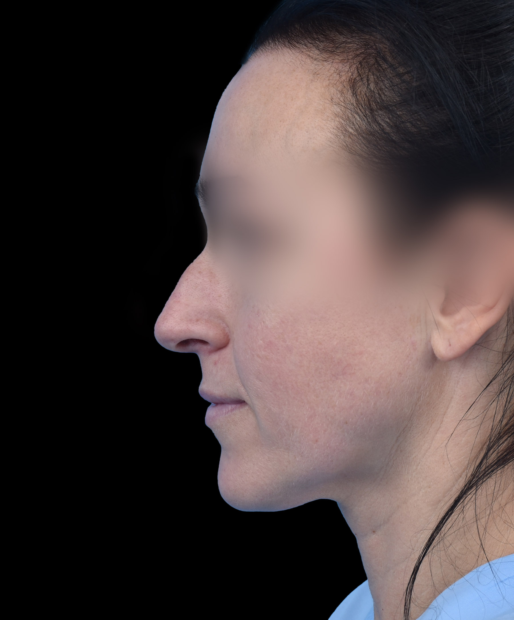 Zdjęcie przedstawia porównanie przed i po operacji korekcji nosa. Po lewej stronie widoczny jest nos pacjenta przed zabiegiem, z widocznymi nierównościami i asymetrią. Po prawej stronie efekt po operacji – nos ma prostszy kształt, jest bardziej symetryczny i harmonijnie dopasowany do rysów twarzy