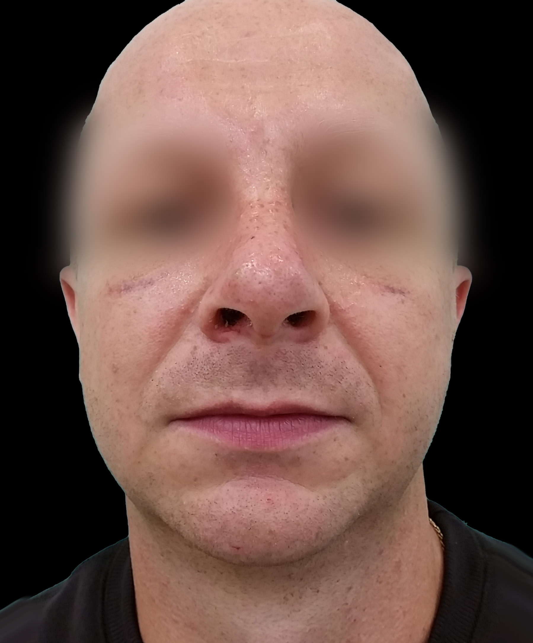 Zdjęcie ukazuje porównanie przed i po operacji korekcji pourazowego zniekształcenia nosa. Przed zabiegiem nos pacjenta wykazuje wyraźne skrzywienie oraz deformacje spowodowane urazem. Po operacji widoczna jest znacząca poprawa – nos jest prosty, symetryczny, a jego kształt został przywrócony do naturalnego wyglądu.