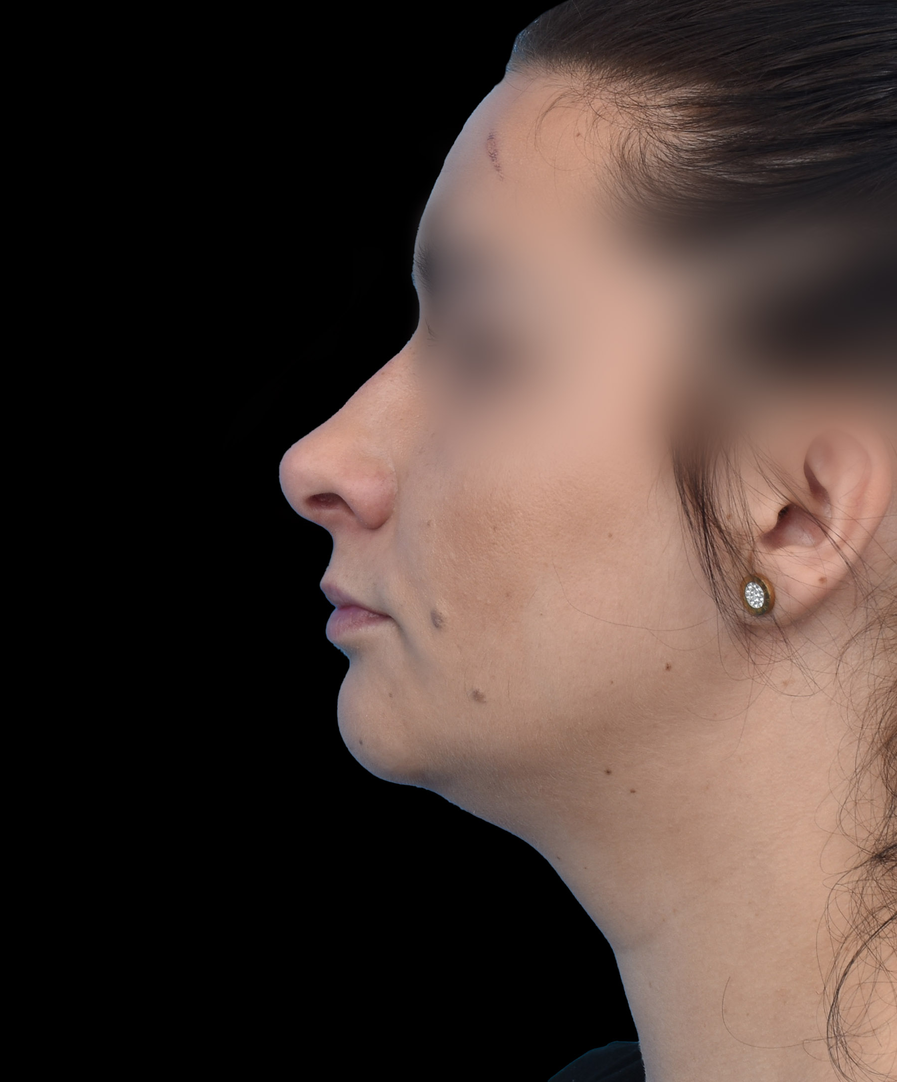 Zdjęcie przedstawia porównanie przed i po operacji korekcji nosa. Po lewej stronie widoczny jest nos pacjenta przed zabiegiem, z widocznymi nierównościami i asymetrią. Po prawej stronie efekt po operacji – nos ma prostszy kształt, jest bardziej symetryczny i harmonijnie dopasowany do rysów twarzy