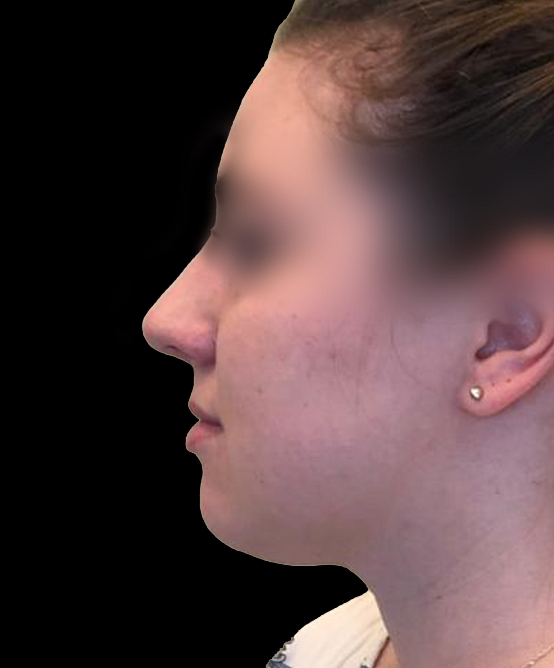 Zdjęcie przedstawia porównanie przed i po operacji korekcji nosa. Po lewej stronie widoczny jest nos pacjenta przed zabiegiem, z widocznymi nierównościami i asymetrią. Po prawej stronie efekt po operacji – nos ma prostszy kształt, jest bardziej symetryczny i harmonijnie dopasowany do rysów twarzy