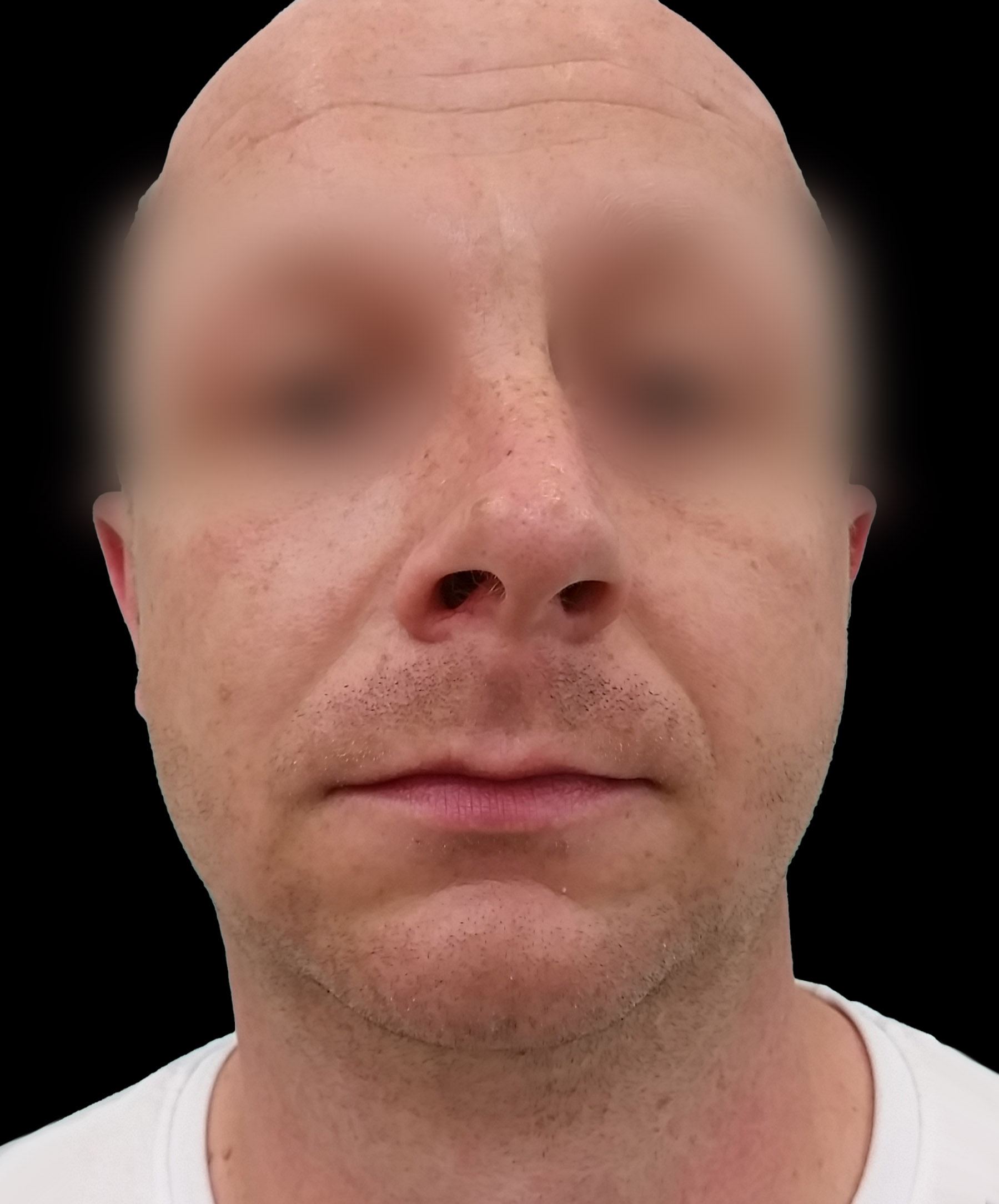 Zdjęcie ukazuje porównanie przed i po operacji korekcji pourazowego zniekształcenia nosa. Przed zabiegiem nos pacjenta wykazuje wyraźne skrzywienie oraz deformacje spowodowane urazem. Po operacji widoczna jest znacząca poprawa – nos jest prosty, symetryczny, a jego kształt został przywrócony do naturalnego wyglądu.