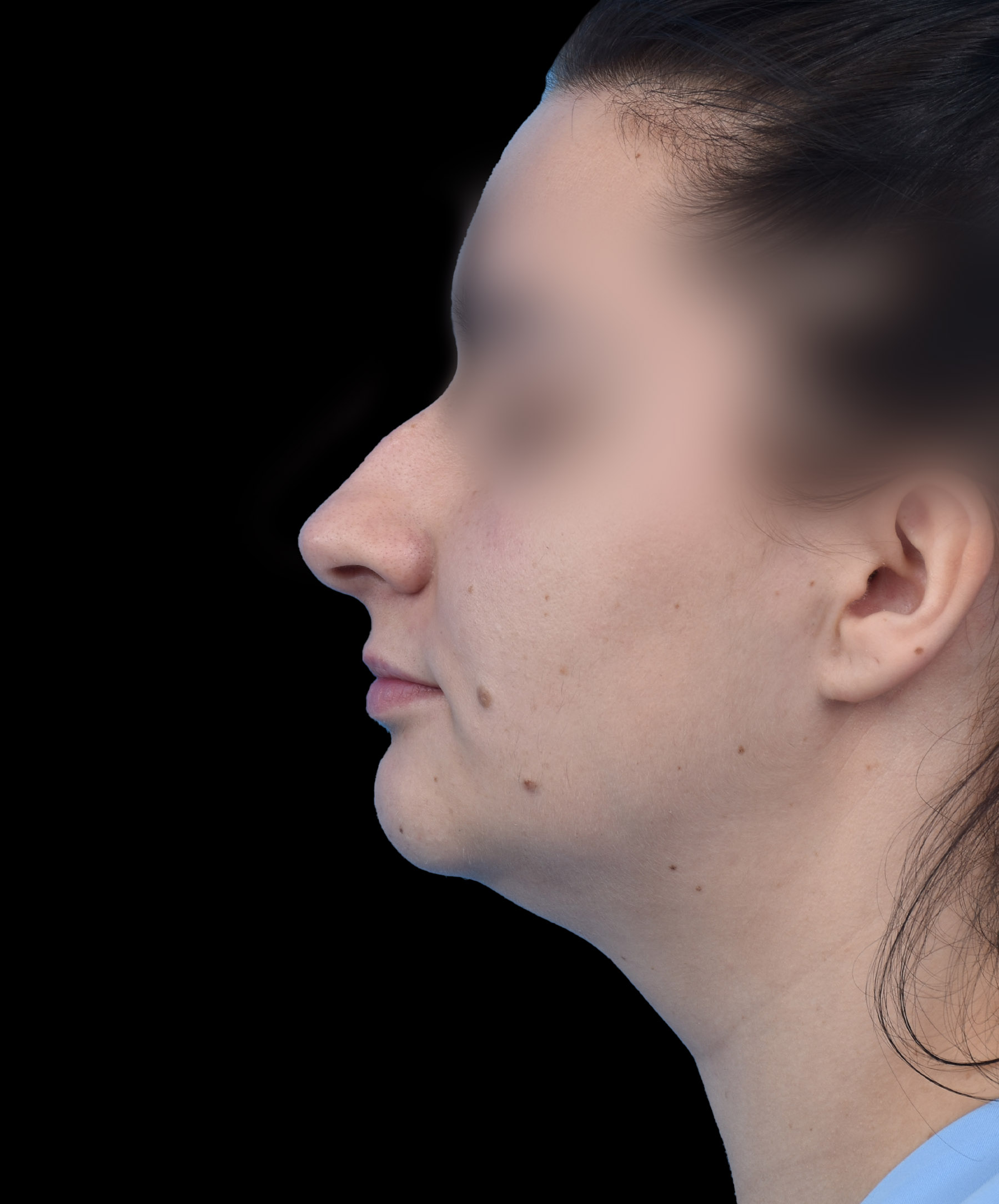 Zdjęcie przedstawia porównanie przed i po operacji korekcji nosa. Po lewej stronie widoczny jest nos pacjenta przed zabiegiem, z widocznymi nierównościami i asymetrią. Po prawej stronie efekt po operacji – nos ma prostszy kształt, jest bardziej symetryczny i harmonijnie dopasowany do rysów twarzy