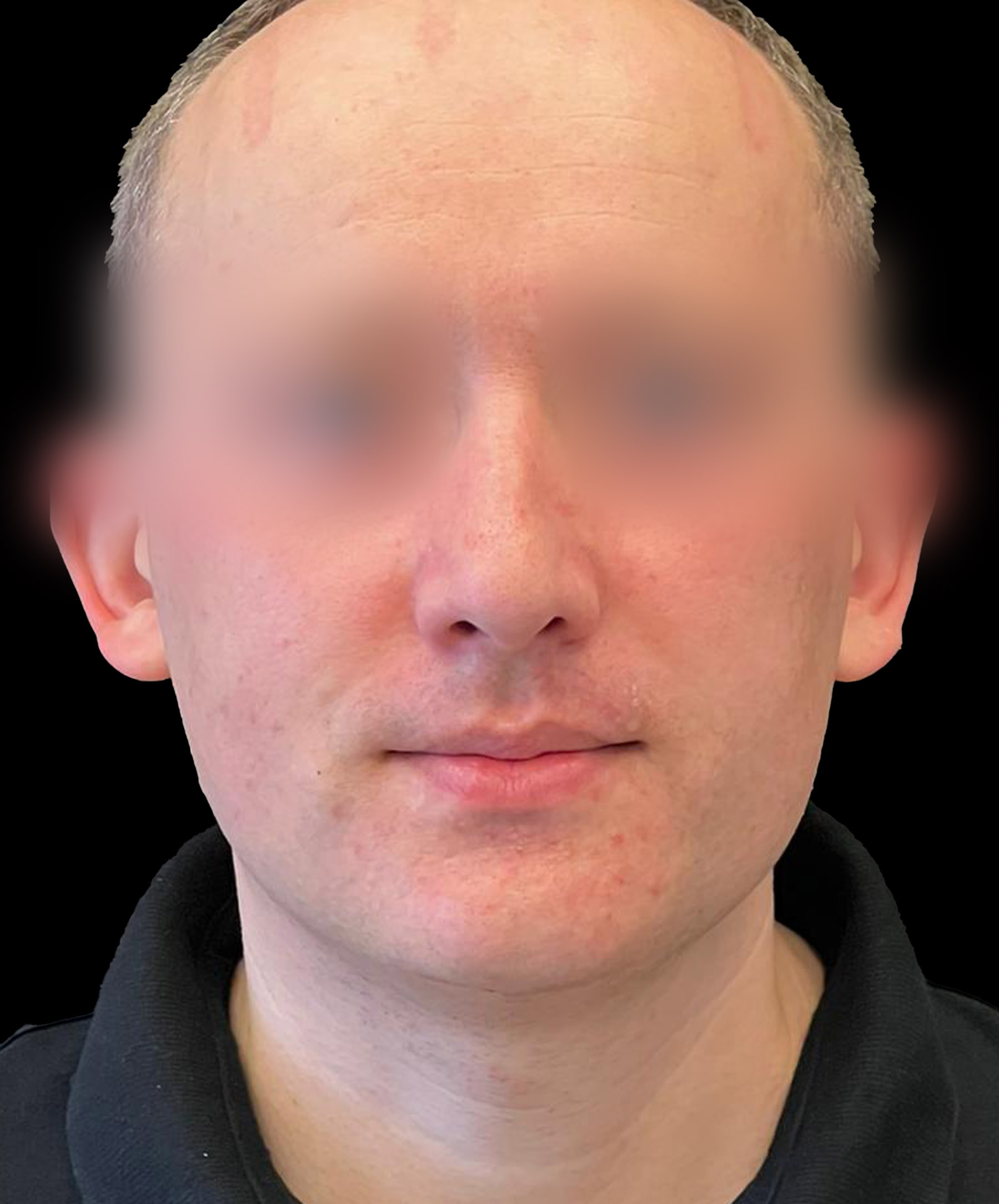 Zdjęcie ukazuje porównanie przed i po operacji korekcji pourazowego zniekształcenia nosa. Przed zabiegiem nos pacjenta wykazuje wyraźne skrzywienie oraz deformacje spowodowane urazem. Po operacji widoczna jest znacząca poprawa – nos jest prosty, symetryczny, a jego kształt został przywrócony do naturalnego wyglądu.