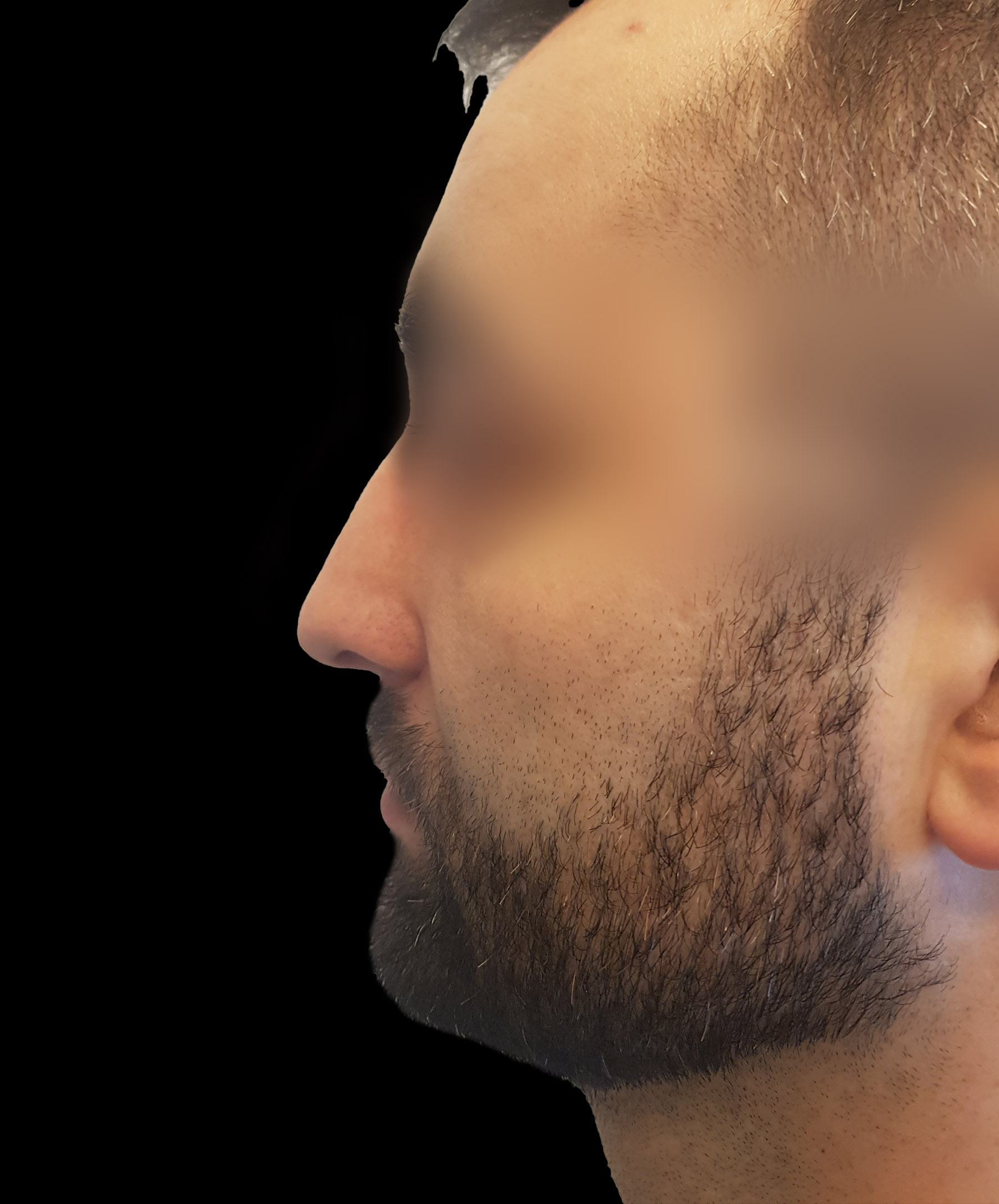 Zdjęcie ukazuje porównanie przed i po operacji korekcji pourazowego zniekształcenia nosa. Przed zabiegiem nos pacjenta wykazuje wyraźne skrzywienie oraz deformacje spowodowane urazem. Po operacji widoczna jest znacząca poprawa – nos jest prosty, symetryczny, a jego kształt został przywrócony do naturalnego wyglądu.