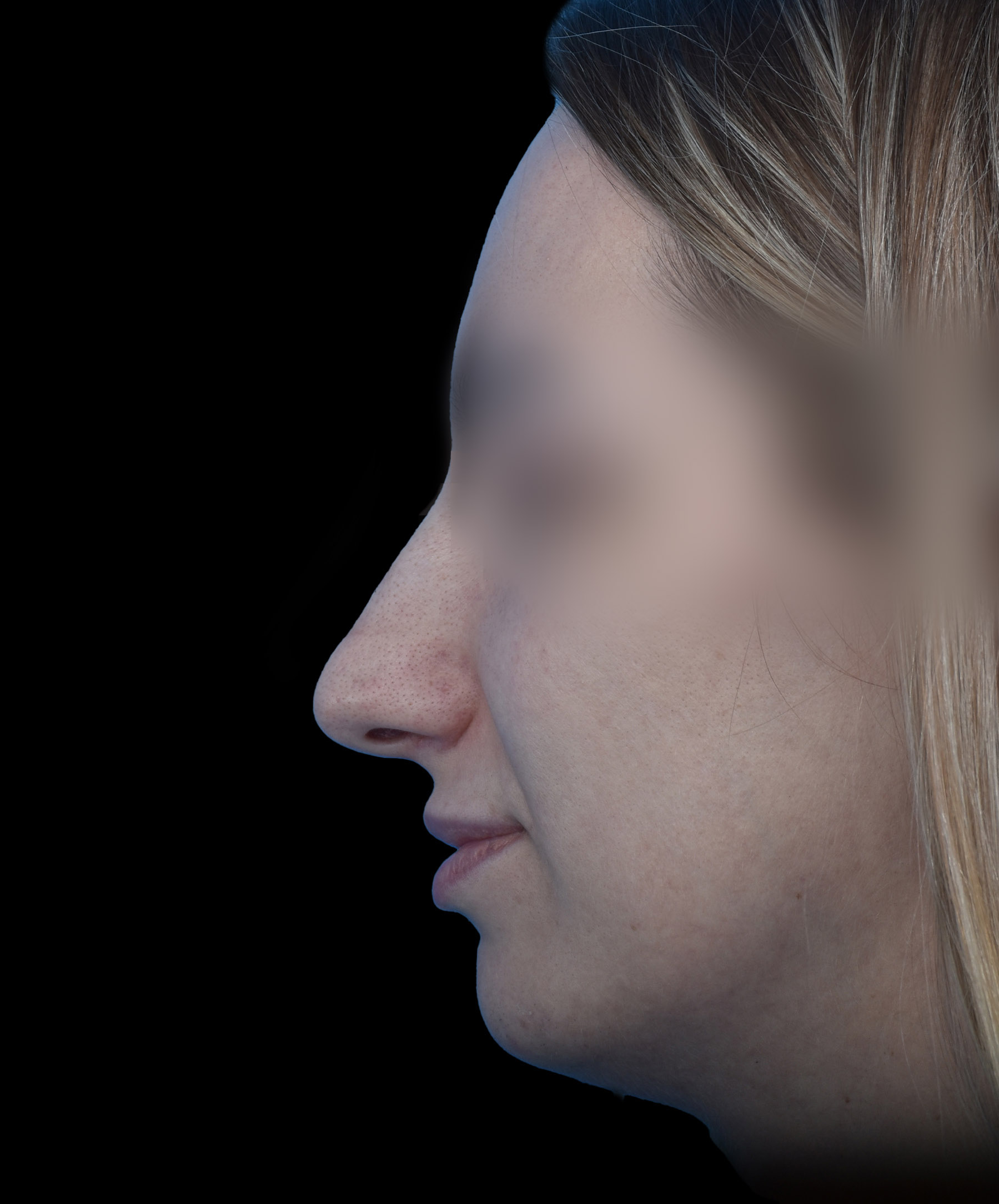 Zdjęcie przedstawia porównanie przed i po operacji korekcji nosa. Po lewej stronie widoczny jest nos pacjenta przed zabiegiem, z widocznymi nierównościami i asymetrią. Po prawej stronie efekt po operacji – nos ma prostszy kształt, jest bardziej symetryczny i harmonijnie dopasowany do rysów twarzy