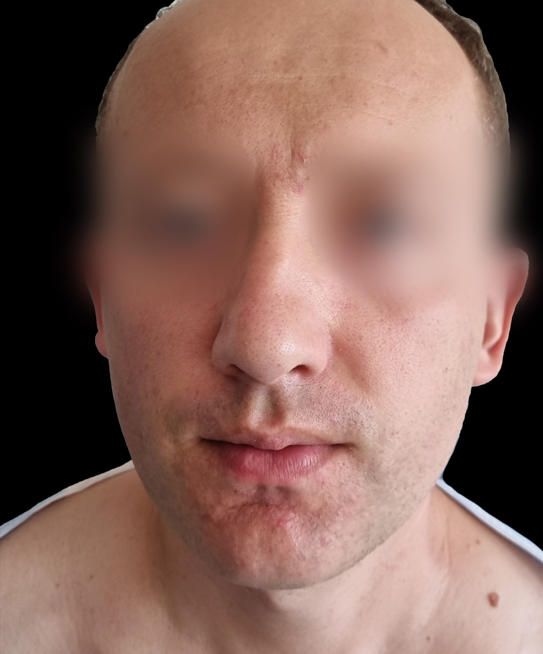 Zdjęcie ukazuje porównanie przed i po operacji korekcji pourazowego zniekształcenia nosa. Przed zabiegiem nos pacjenta wykazuje wyraźne skrzywienie oraz deformacje spowodowane urazem. Po operacji widoczna jest znacząca poprawa – nos jest prosty, symetryczny, a jego kształt został przywrócony do naturalnego wyglądu.