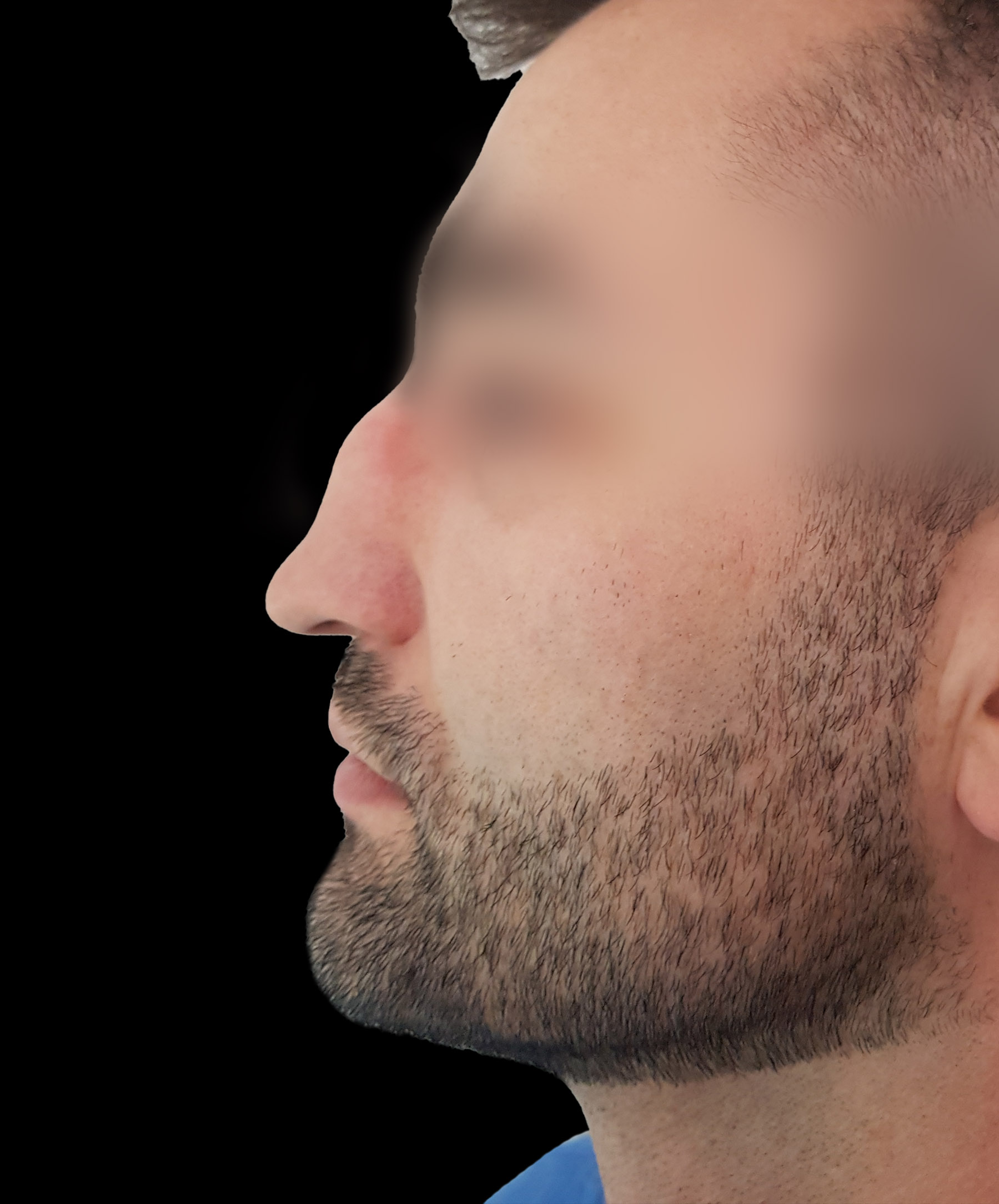 Zdjęcie ukazuje porównanie przed i po operacji korekcji pourazowego zniekształcenia nosa. Przed zabiegiem nos pacjenta wykazuje wyraźne skrzywienie oraz deformacje spowodowane urazem. Po operacji widoczna jest znacząca poprawa – nos jest prosty, symetryczny, a jego kształt został przywrócony do naturalnego wyglądu.