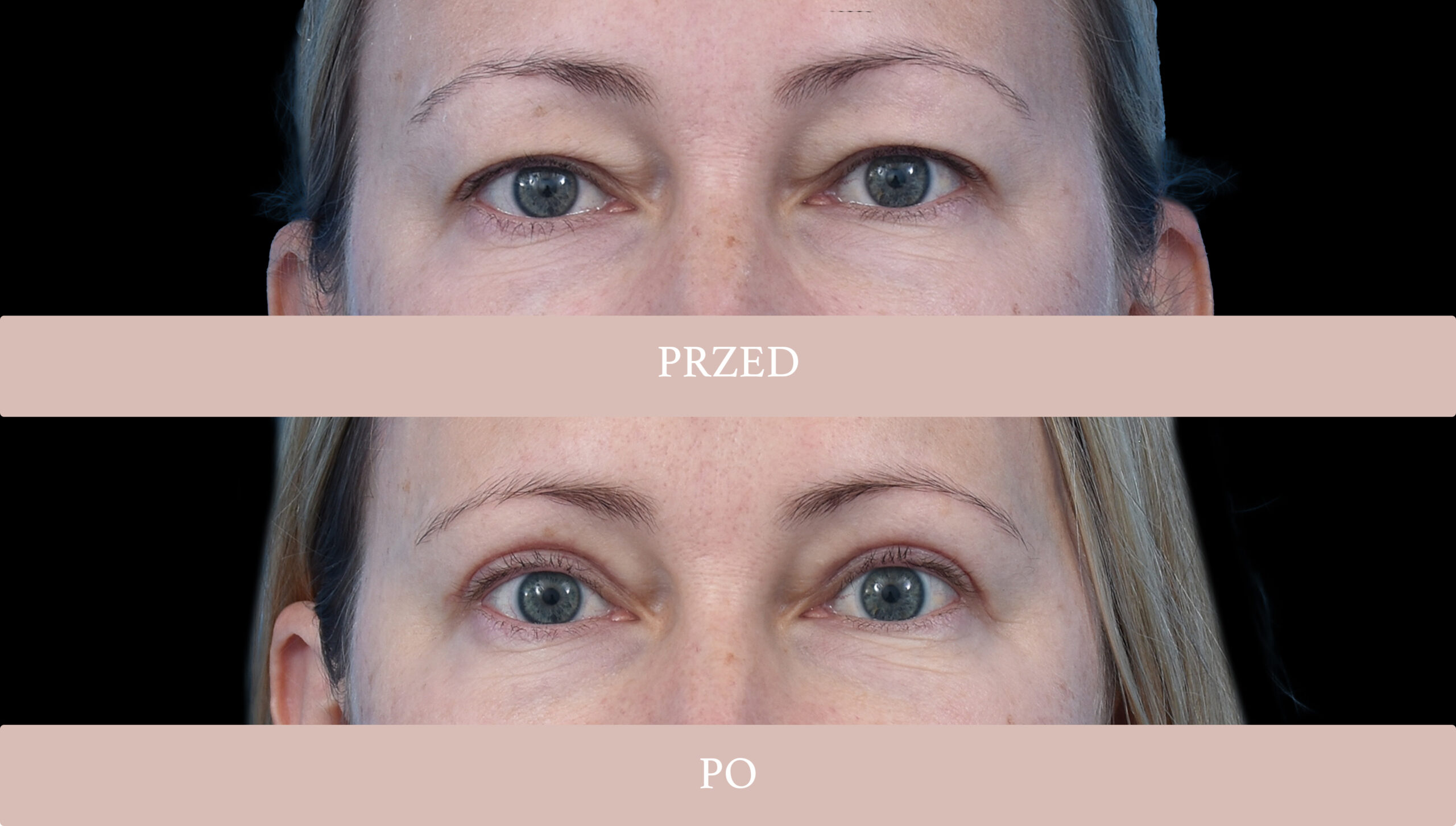 Stan przedoperacyjny ginekomastii