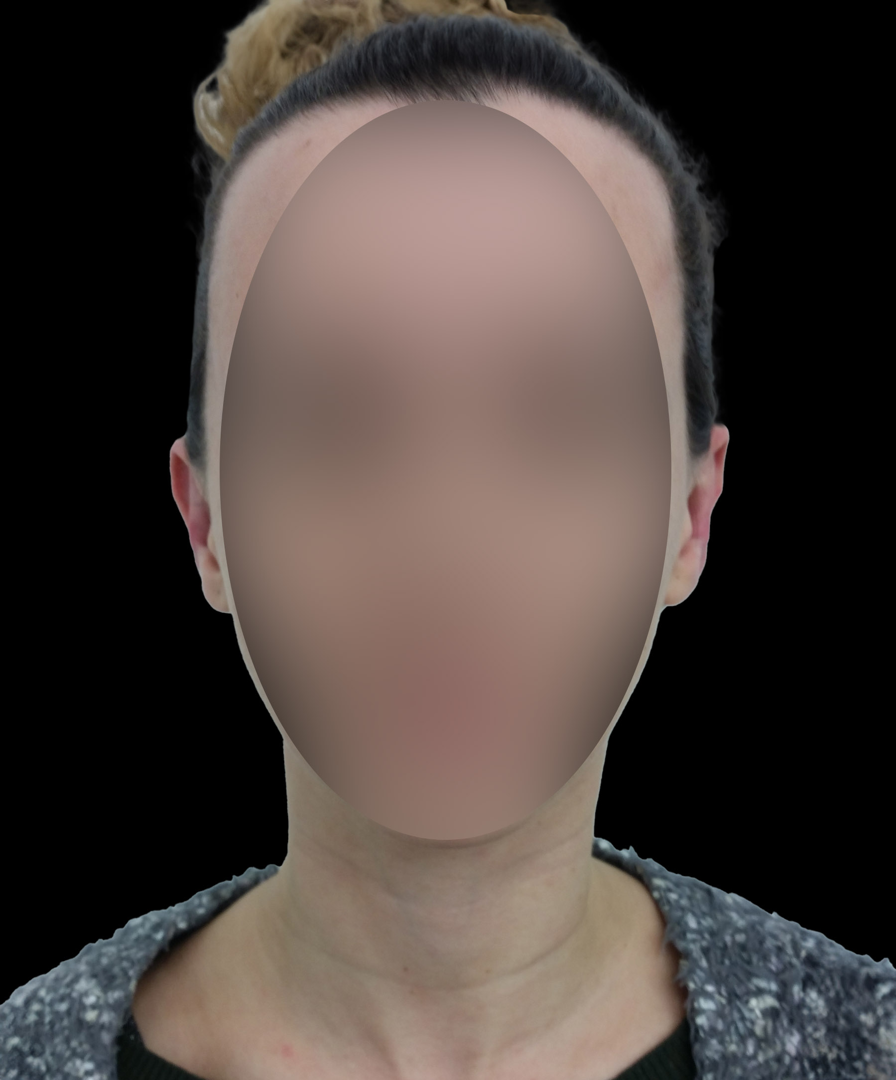 Zdjęcie przedstawiające pacjentkę po zabiegu korekcji odstających małżowin usznych