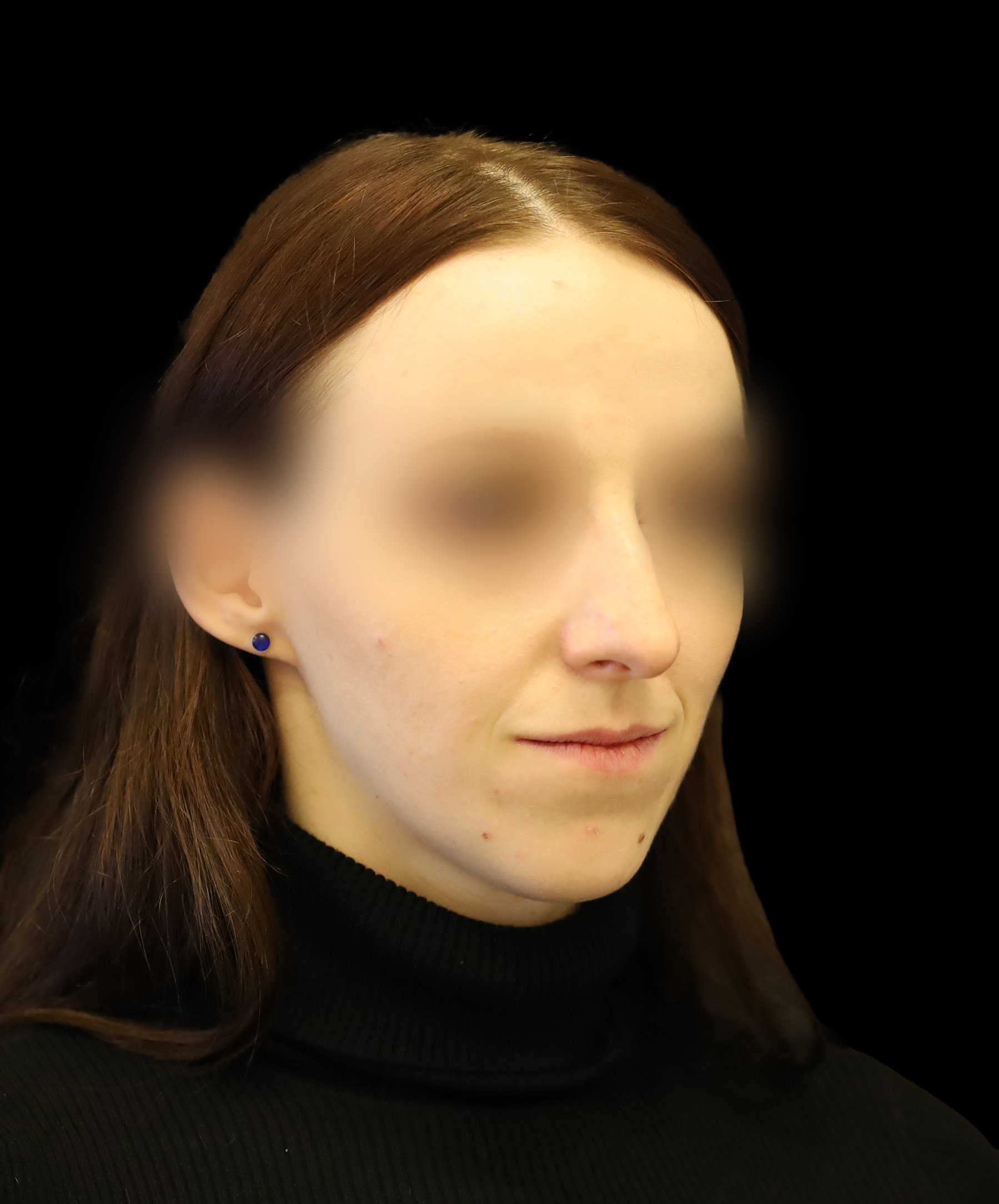 Zdjęcie ukazuje porównanie przed i po operacji korekcji pourazowego zniekształcenia nosa. Przed zabiegiem nos pacjenta wykazuje wyraźne skrzywienie oraz deformacje spowodowane urazem. Po operacji widoczna jest znacząca poprawa – nos jest prosty, symetryczny, a jego kształt został przywrócony do naturalnego wyglądu.