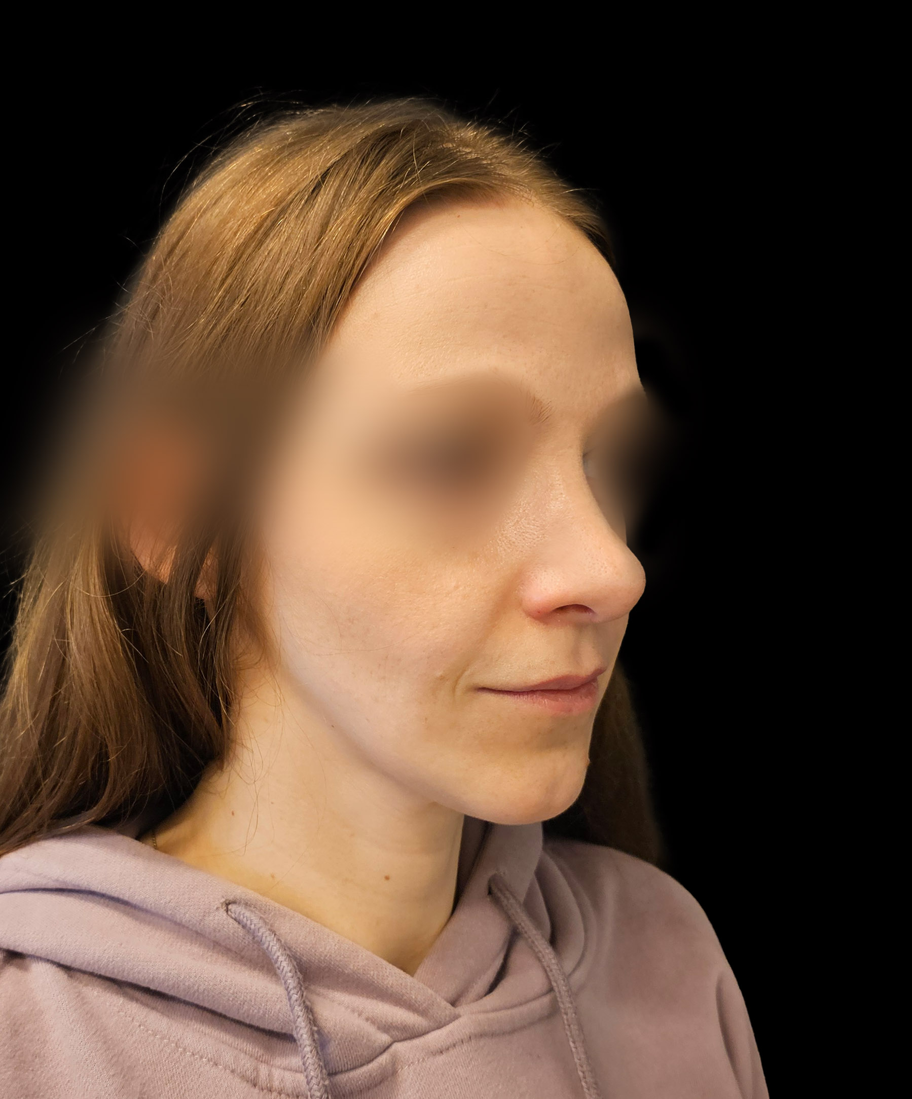 Zdjęcie ukazuje porównanie przed i po operacji korekcji pourazowego zniekształcenia nosa. Przed zabiegiem nos pacjenta wykazuje wyraźne skrzywienie oraz deformacje spowodowane urazem. Po operacji widoczna jest znacząca poprawa – nos jest prosty, symetryczny, a jego kształt został przywrócony do naturalnego wyglądu.