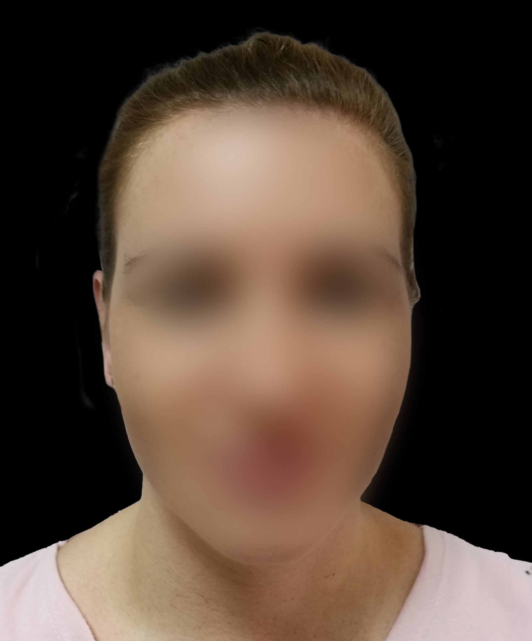 Zdjęcie przedstawiające pacjentkę po zabiegu korekcji odstających małżowin usznych