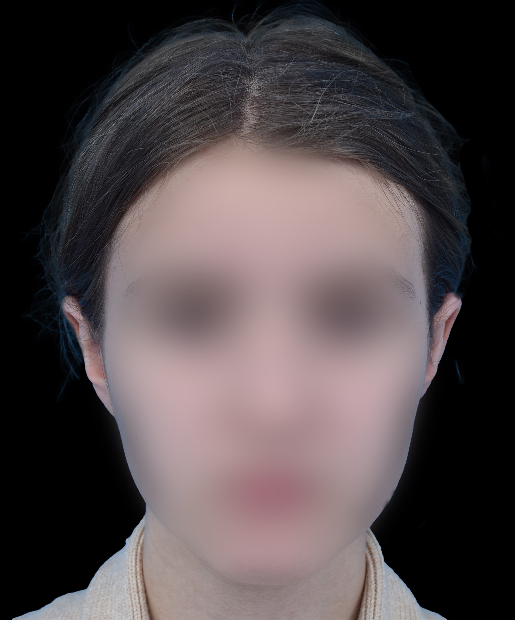 Zdjęcie przedstawiające pacjentkę po zabiegu korekcji odstających małżowin usznych