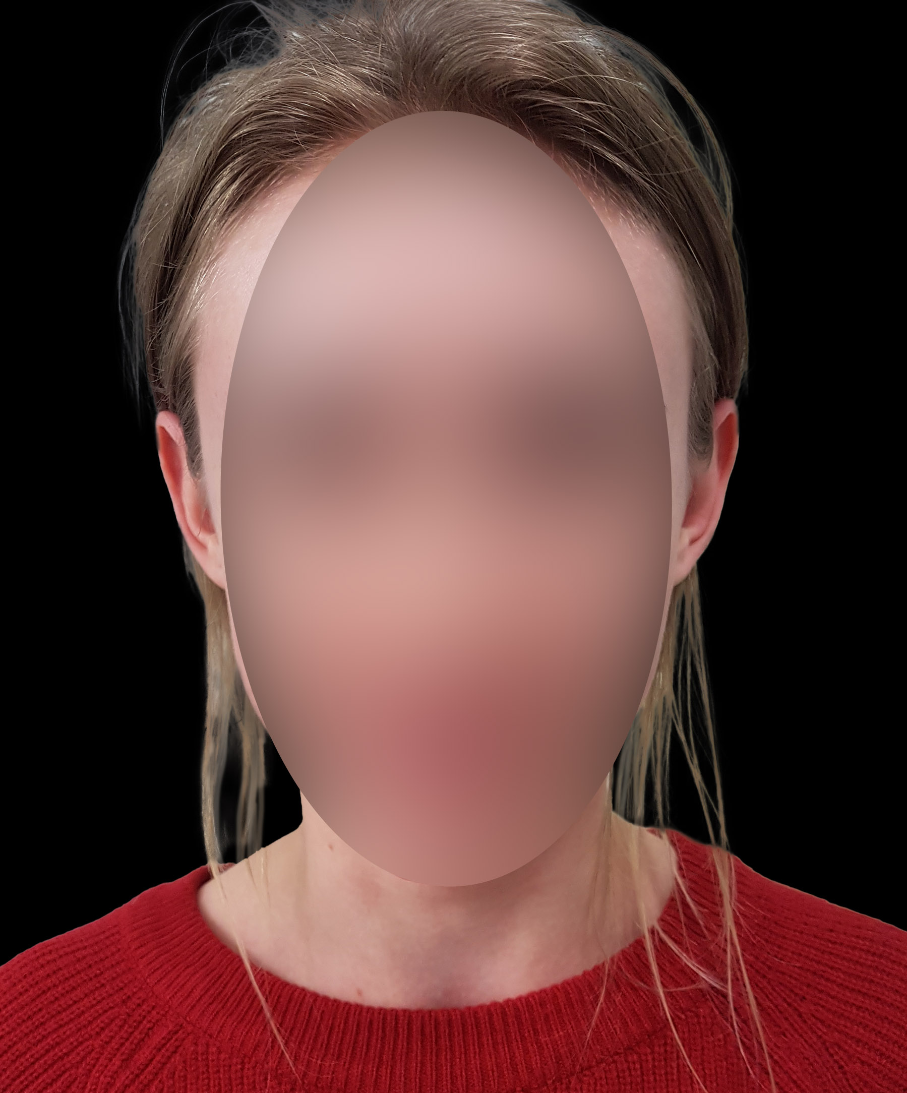 Zdjęcie przedstawiające pacjentkę z odstającymi uszmi