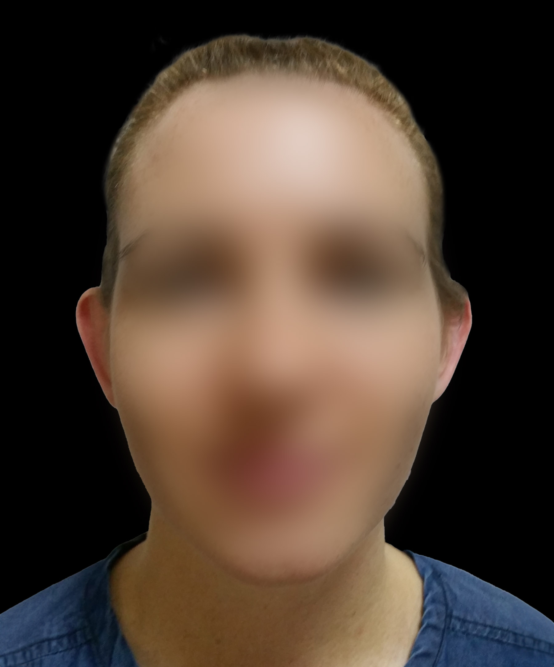 Zdjęcie przedstawiające pacjentkę z odstającymi uszmi