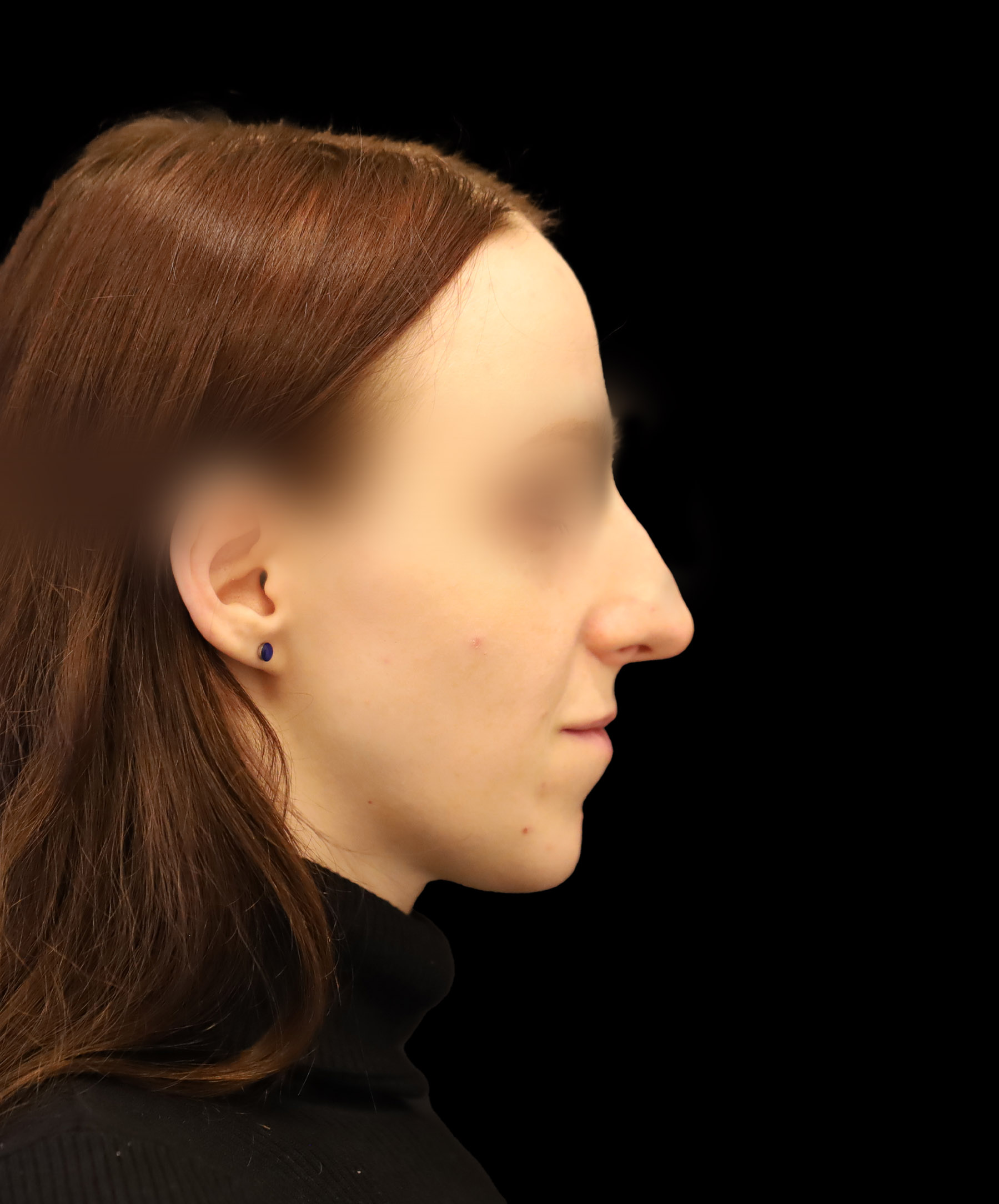 Zdjęcie ukazuje porównanie przed i po operacji korekcji pourazowego zniekształcenia nosa. Przed zabiegiem nos pacjenta wykazuje wyraźne skrzywienie oraz deformacje spowodowane urazem. Po operacji widoczna jest znacząca poprawa – nos jest prosty, symetryczny, a jego kształt został przywrócony do naturalnego wyglądu.