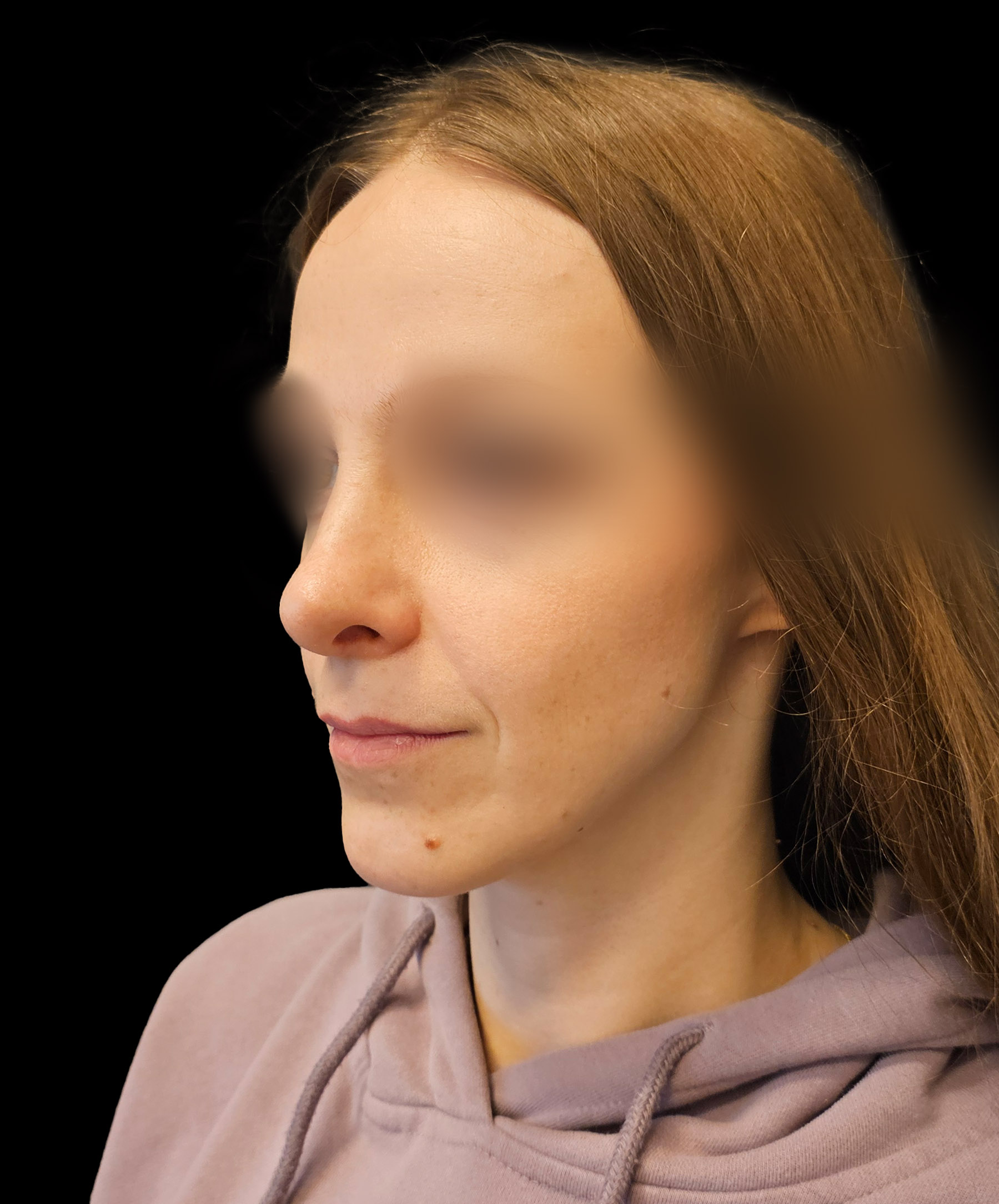 Zdjęcie ukazuje porównanie przed i po operacji korekcji pourazowego zniekształcenia nosa. Przed zabiegiem nos pacjenta wykazuje wyraźne skrzywienie oraz deformacje spowodowane urazem. Po operacji widoczna jest znacząca poprawa – nos jest prosty, symetryczny, a jego kształt został przywrócony do naturalnego wyglądu.