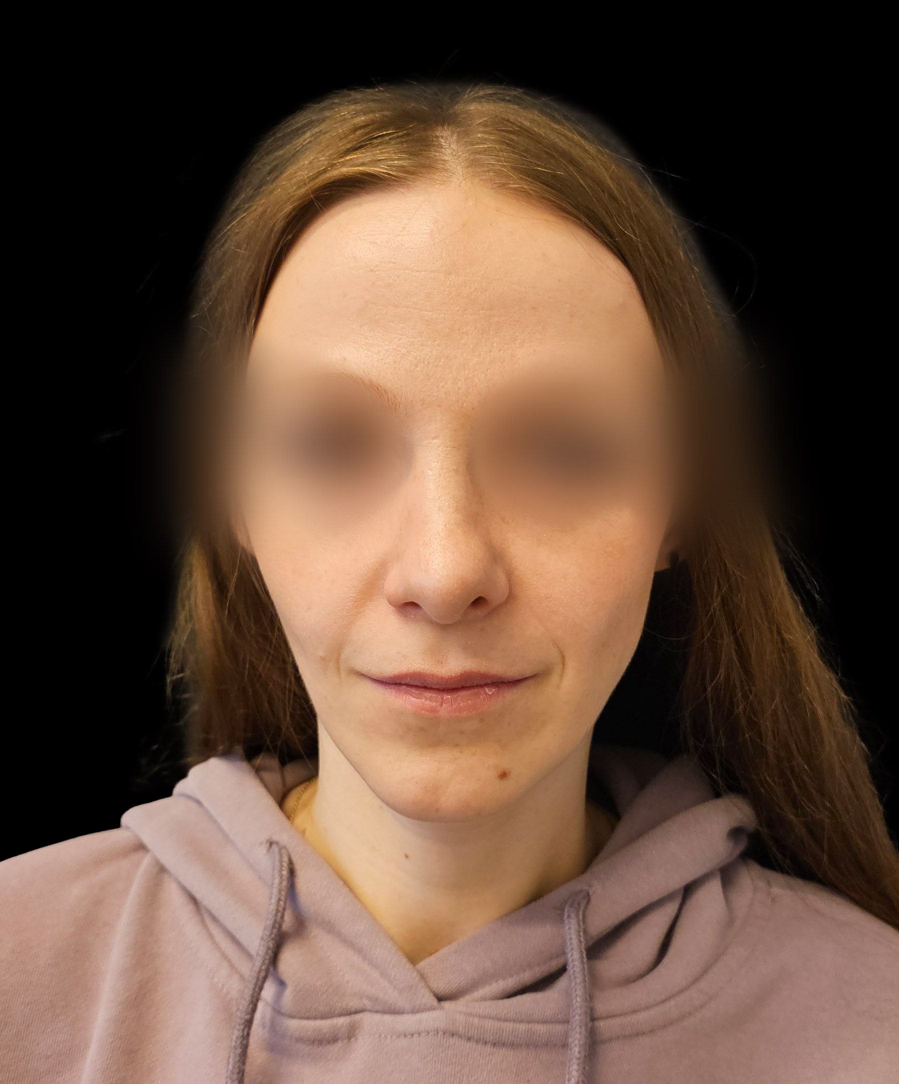 Zdjęcie ukazuje porównanie przed i po operacji korekcji pourazowego zniekształcenia nosa. Przed zabiegiem nos pacjenta wykazuje wyraźne skrzywienie oraz deformacje spowodowane urazem. Po operacji widoczna jest znacząca poprawa – nos jest prosty, symetryczny, a jego kształt został przywrócony do naturalnego wyglądu.