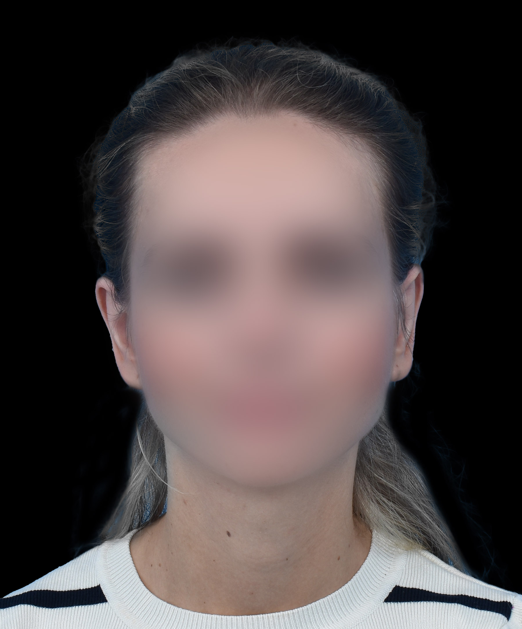 Zdjęcie przedstawiające pacjentkę po zabiegu korekcji odstających małżowin usznych