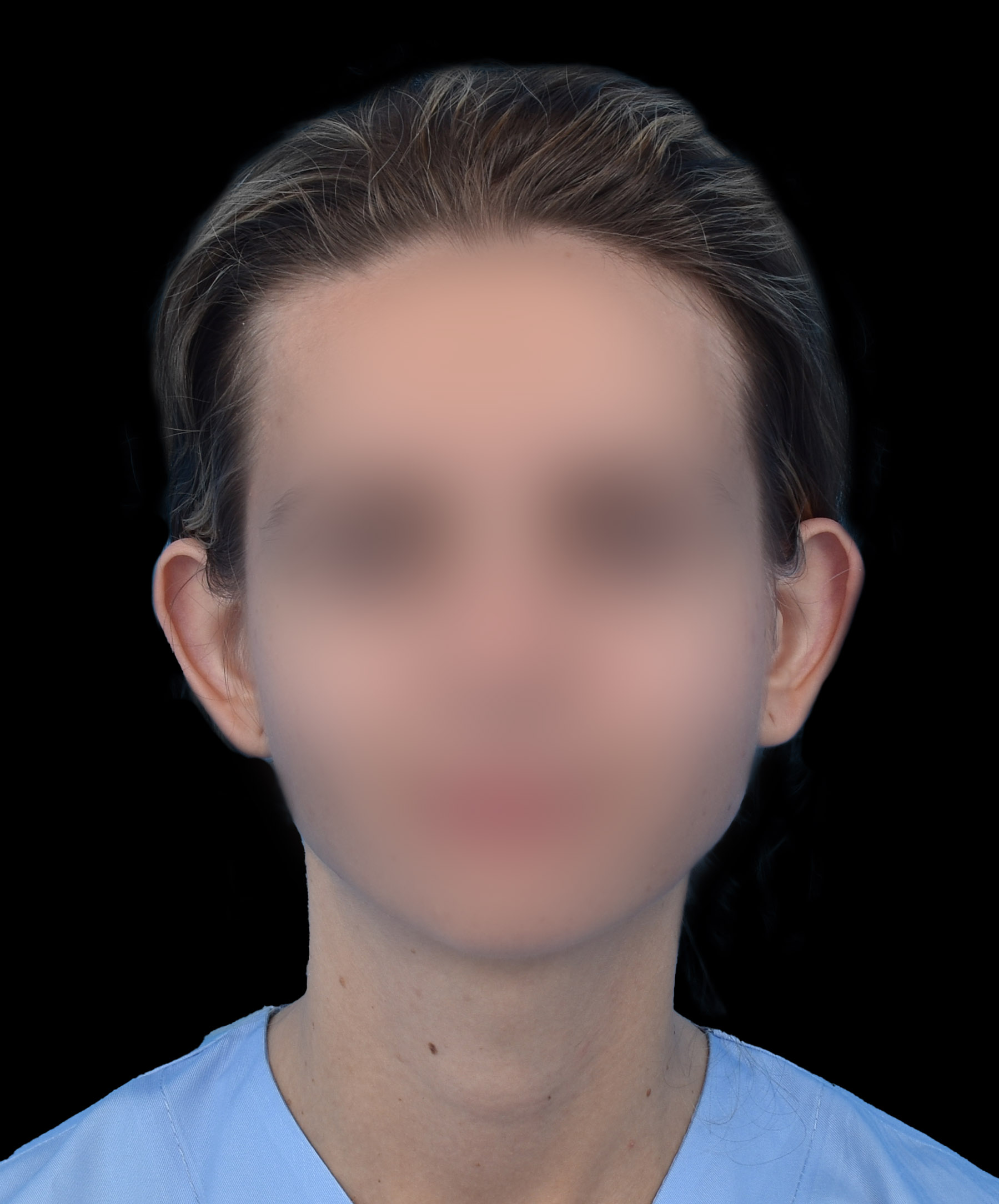 Zdjęcie przedstawiające pacjentkę z odstającymi uszmi