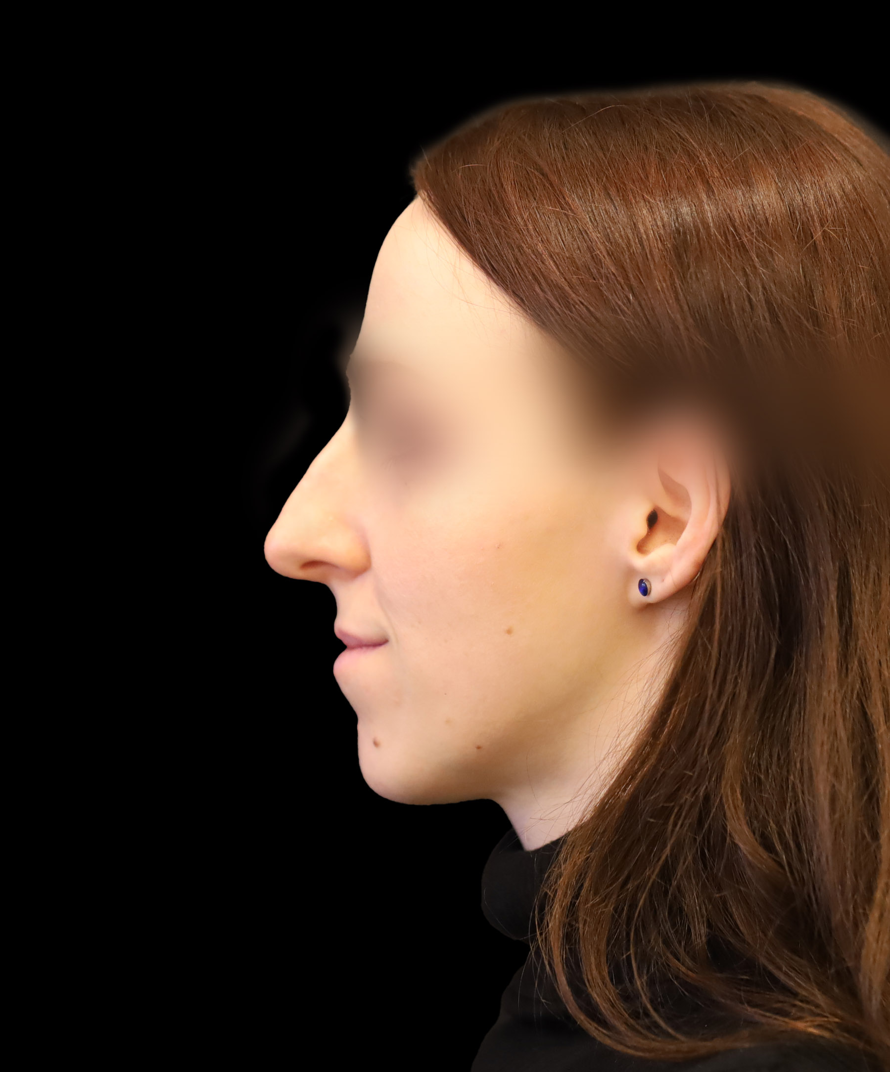 Zdjęcie ukazuje porównanie przed i po operacji korekcji pourazowego zniekształcenia nosa. Przed zabiegiem nos pacjenta wykazuje wyraźne skrzywienie oraz deformacje spowodowane urazem. Po operacji widoczna jest znacząca poprawa – nos jest prosty, symetryczny, a jego kształt został przywrócony do naturalnego wyglądu.