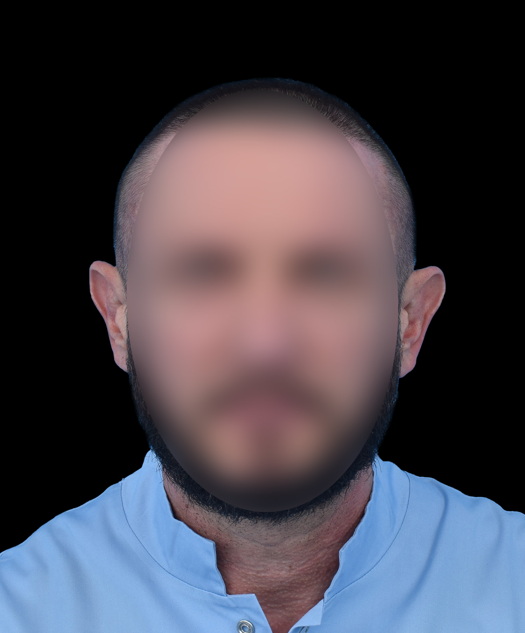 Zdjęcie przedstawiające pacjentkę z odstającymi uszmi