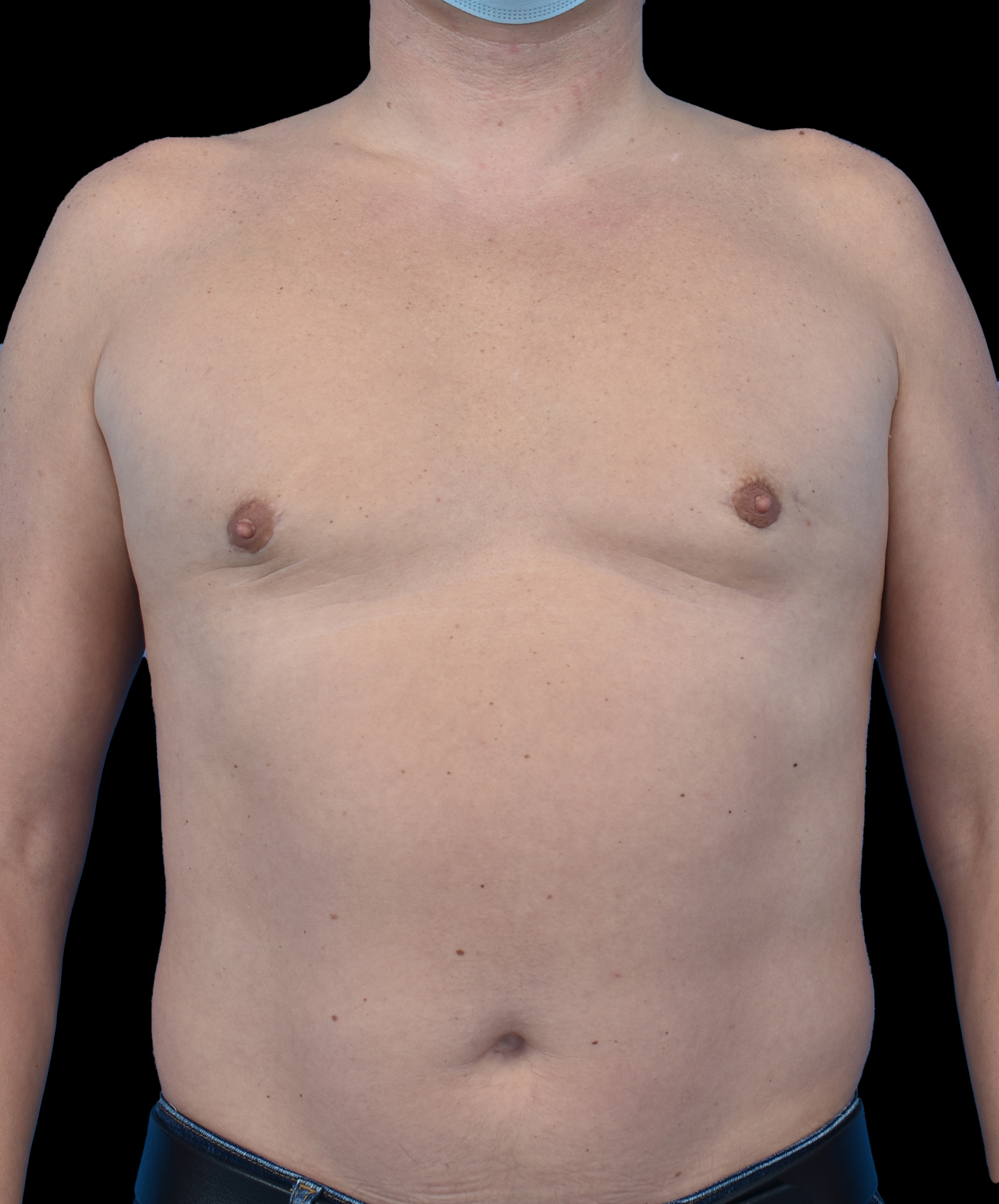 Stan pooperacyjny ginekomastii