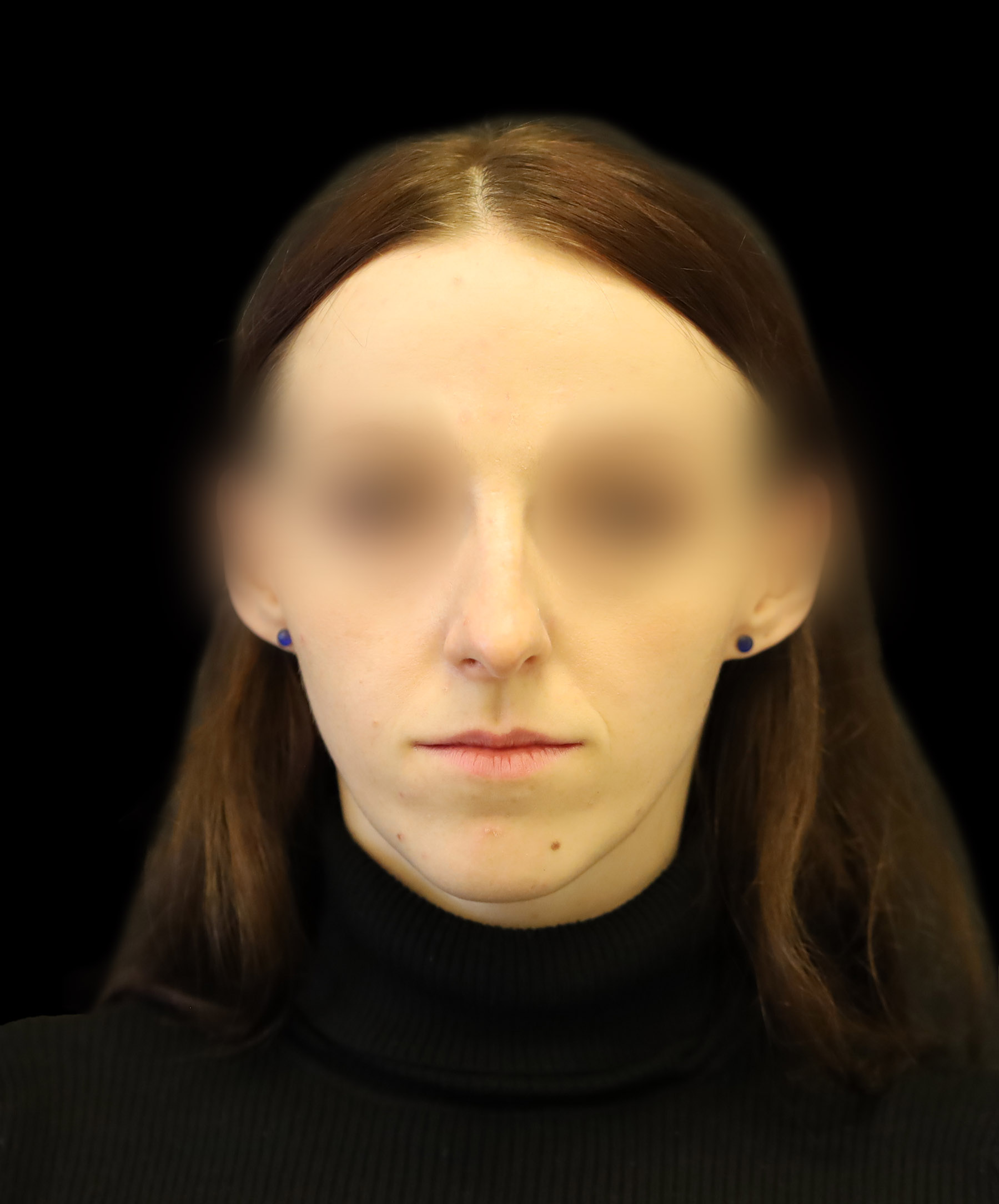 Zdjęcie ukazuje porównanie przed i po operacji korekcji pourazowego zniekształcenia nosa. Przed zabiegiem nos pacjenta wykazuje wyraźne skrzywienie oraz deformacje spowodowane urazem. Po operacji widoczna jest znacząca poprawa – nos jest prosty, symetryczny, a jego kształt został przywrócony do naturalnego wyglądu.