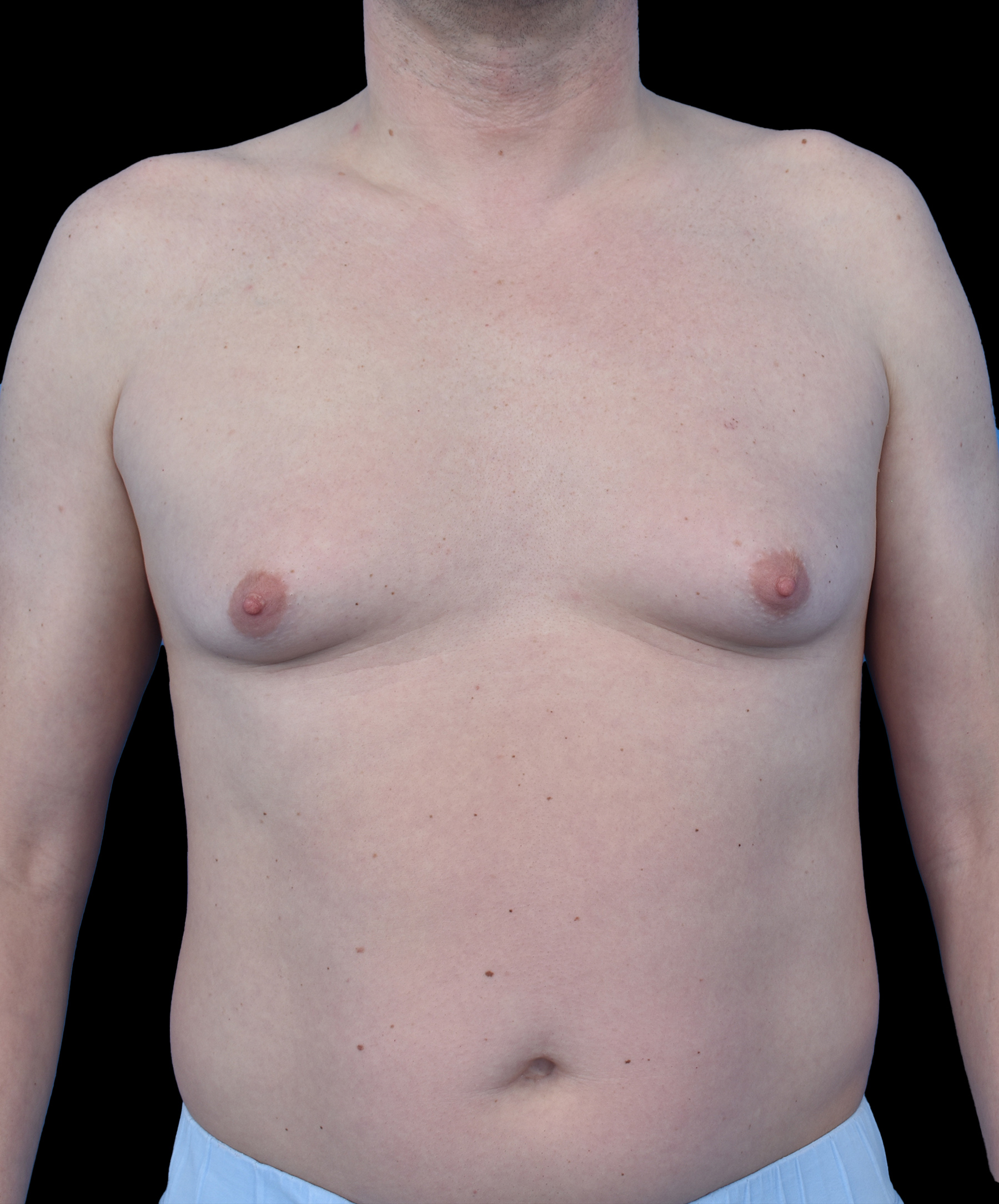 Stan przedoperacyjny ginekomastii