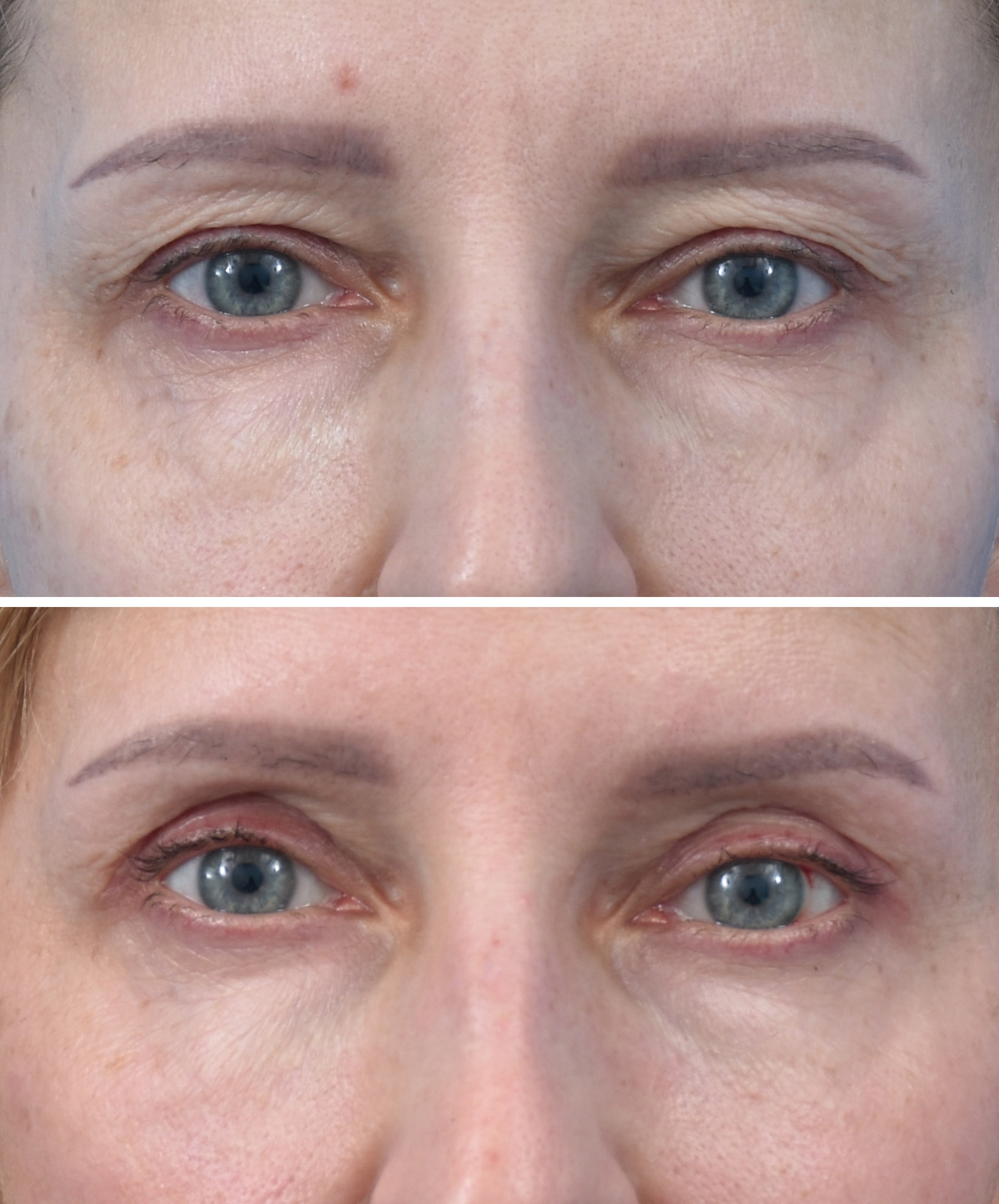 Blefaroplastyka Wrocław dr Kołacz – precyzyjny efekt przed i po plastyce powiek