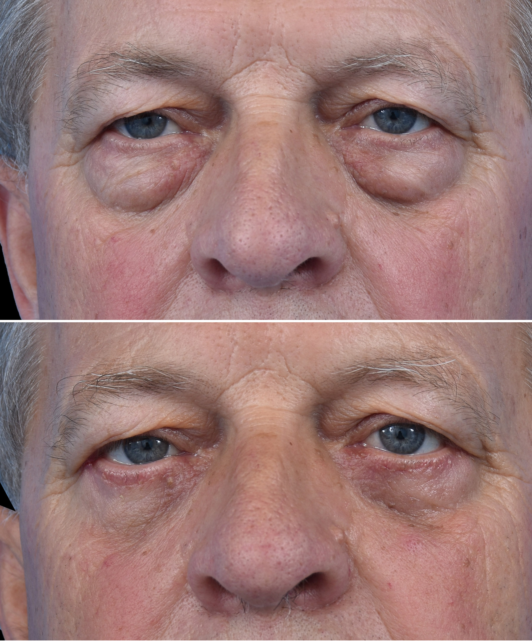 Stan przedoperacyjny ginekomastii