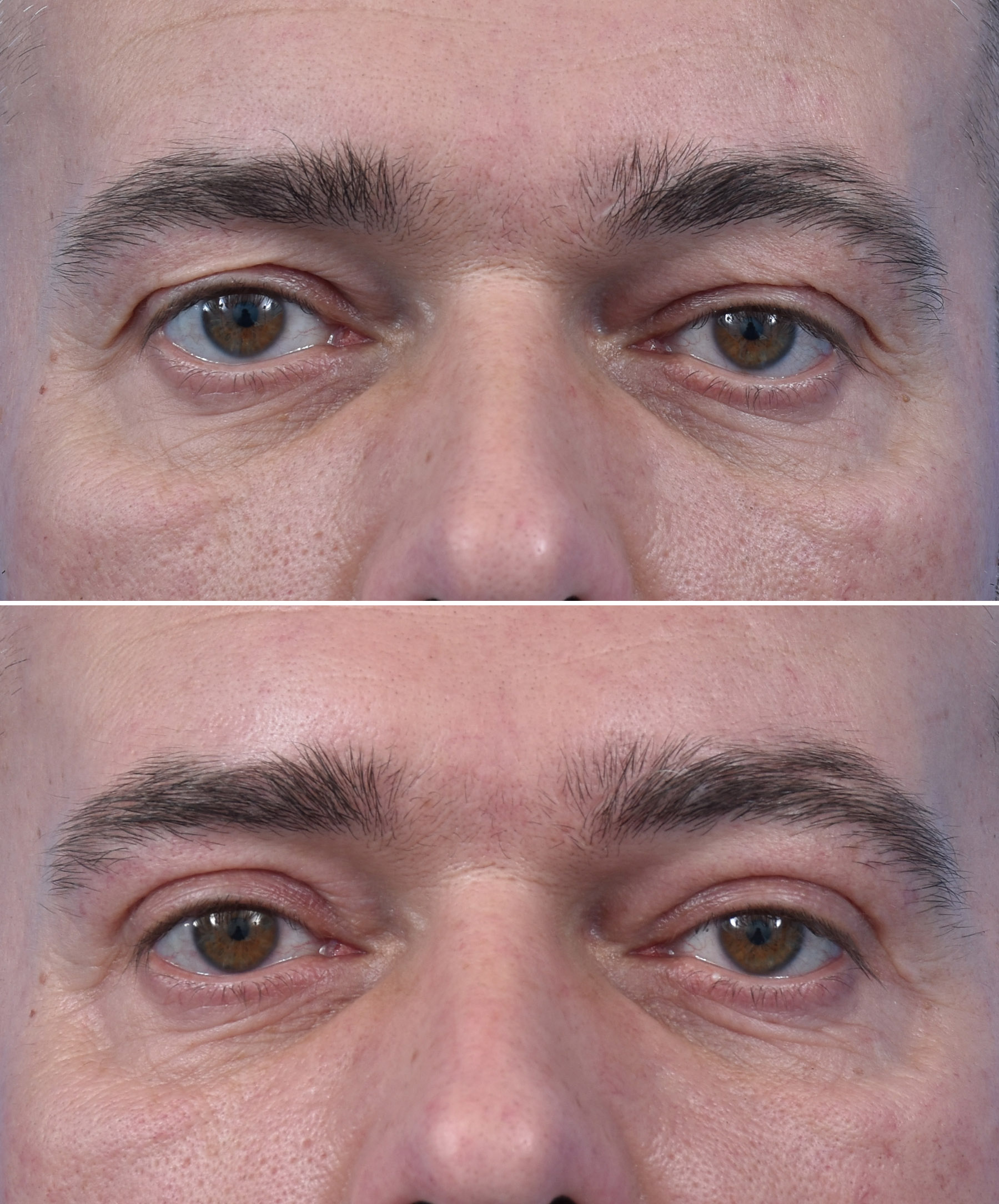 Stan przedoperacyjny ginekomastii