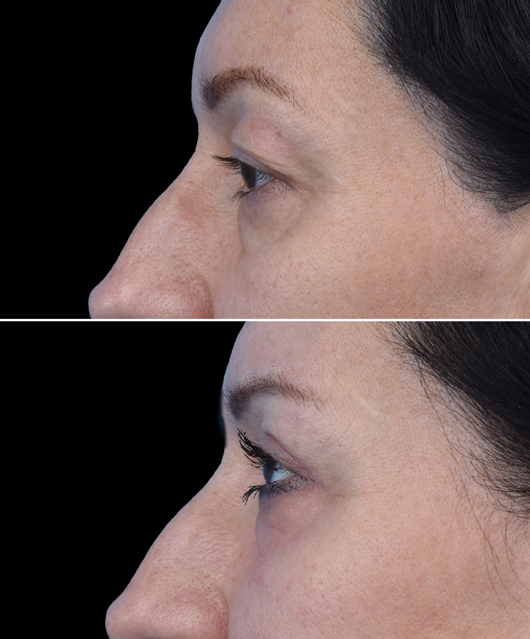 Stan pooperacyjny ginekomastii