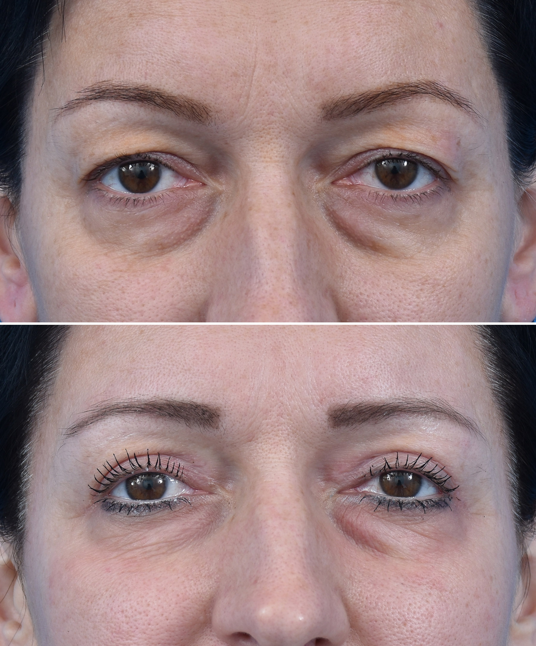 Stan przedoperacyjny ginekomastii