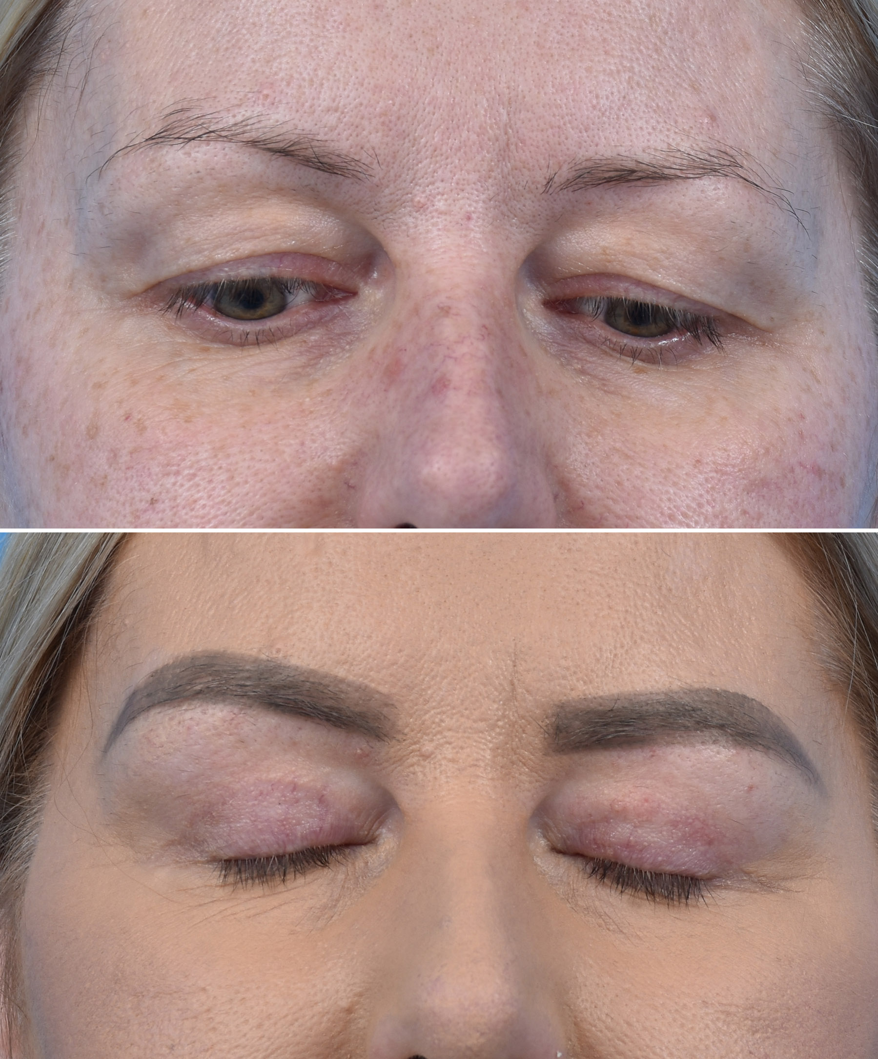 Stan pooperacyjny ginekomastii