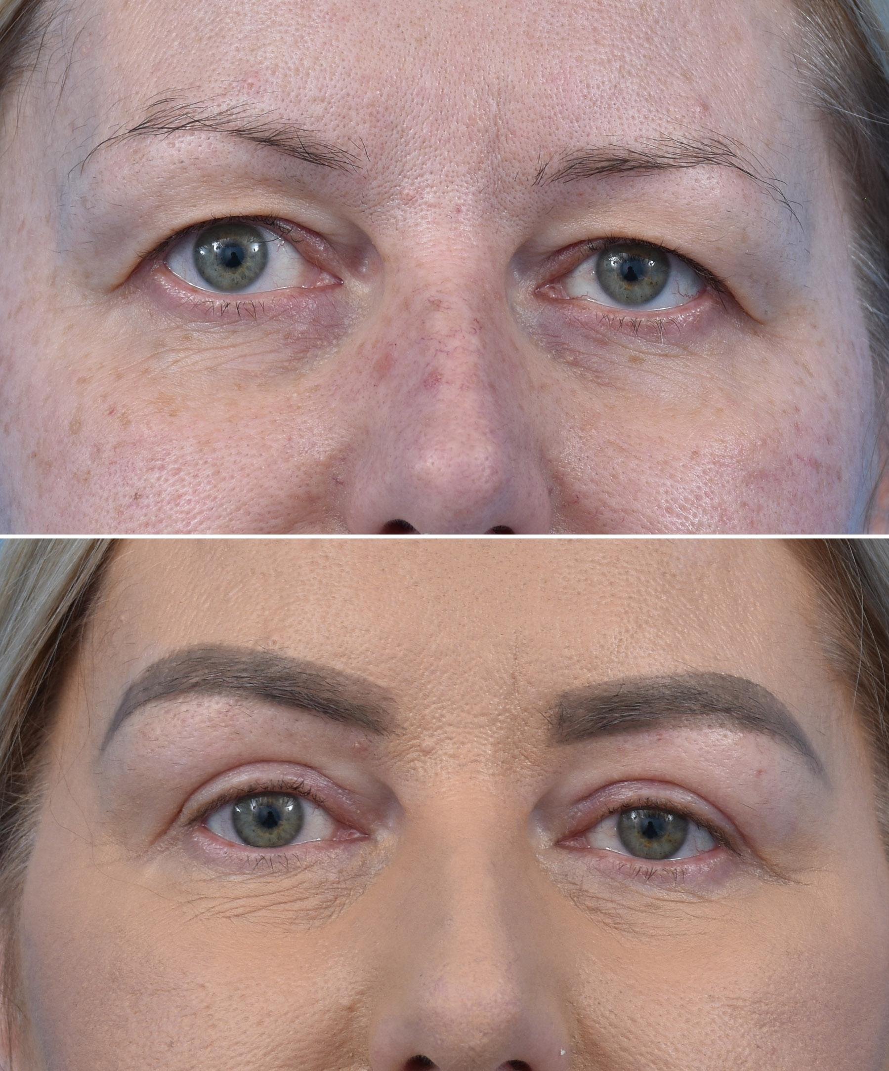 Stan przedoperacyjny ginekomastii