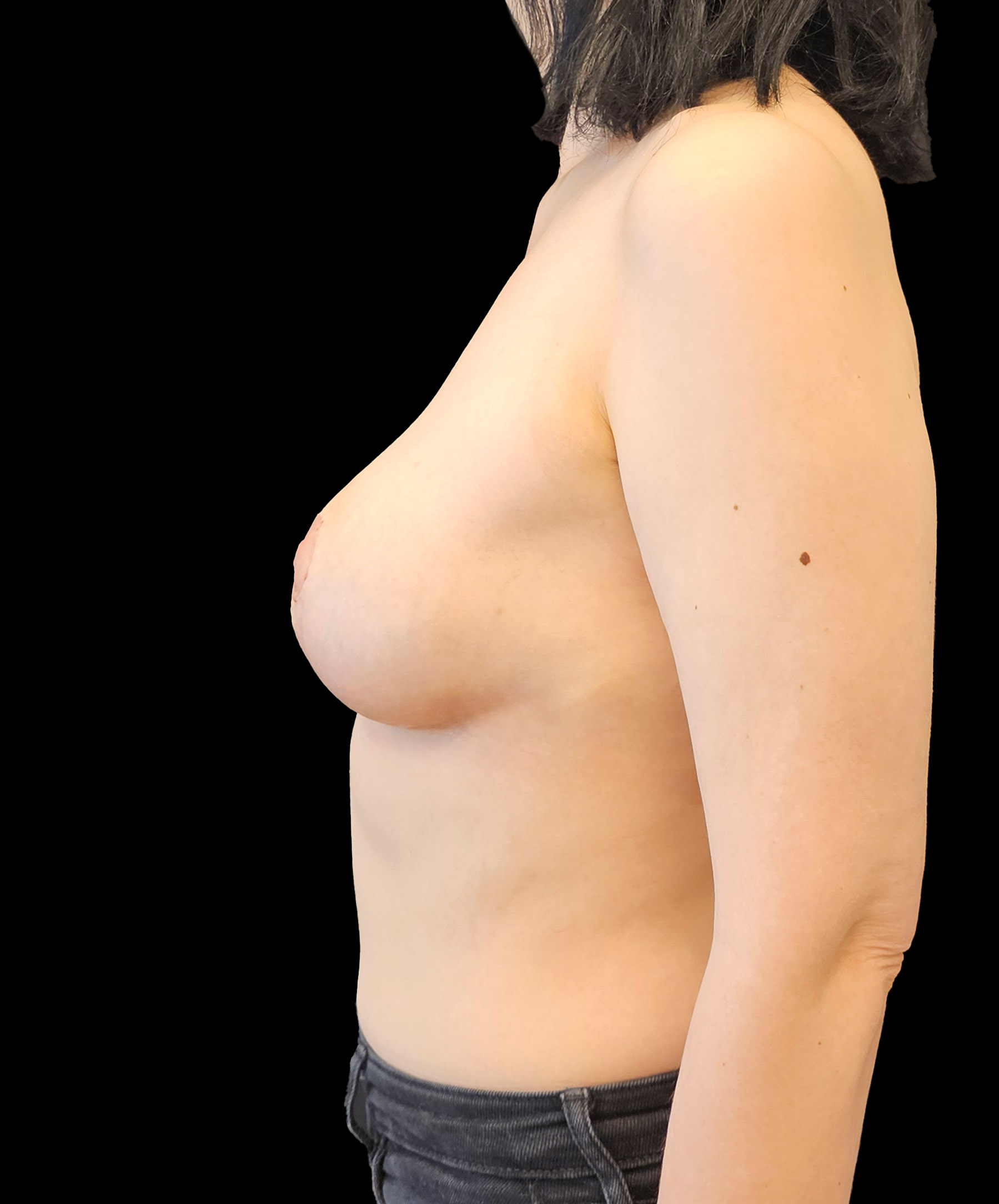 Profil biustu po zmniejszeniu wykonanym przez dr Kołacza we Wrocławiu