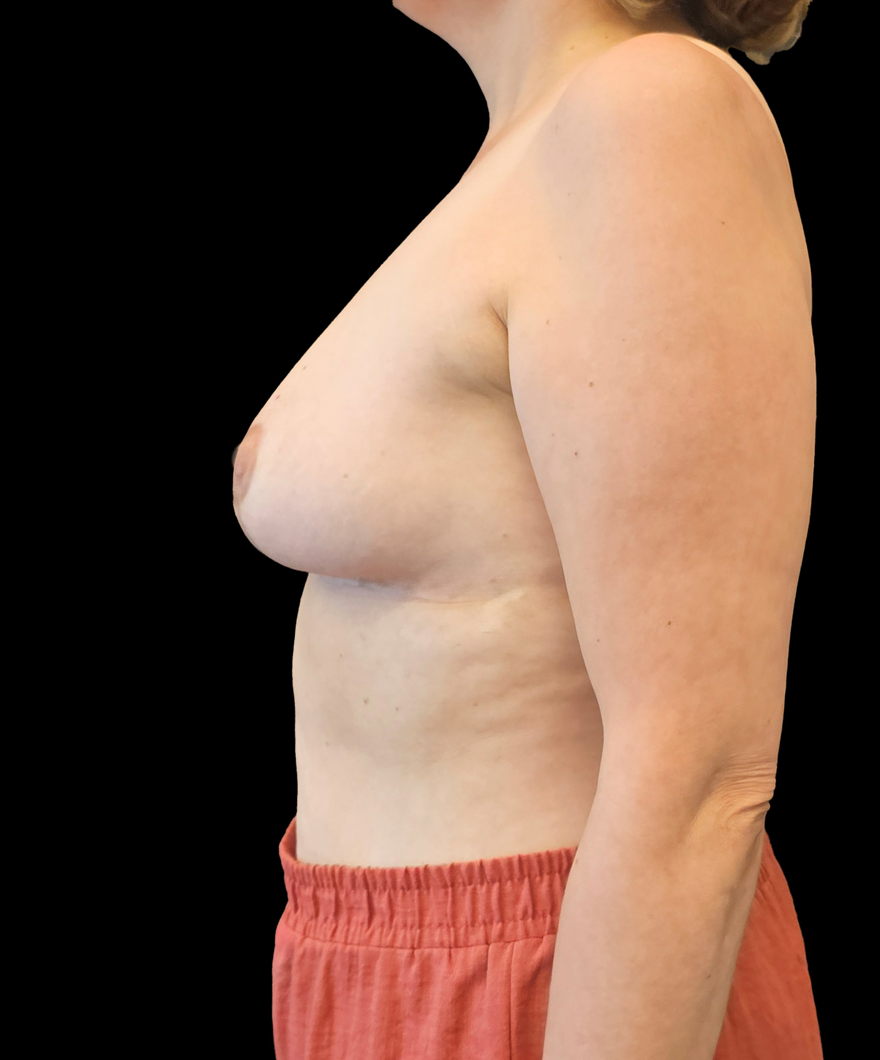 Naturalny kształt piersi po zmniejszeniu wykonanym przez dr Kołacza we Wrocławiu