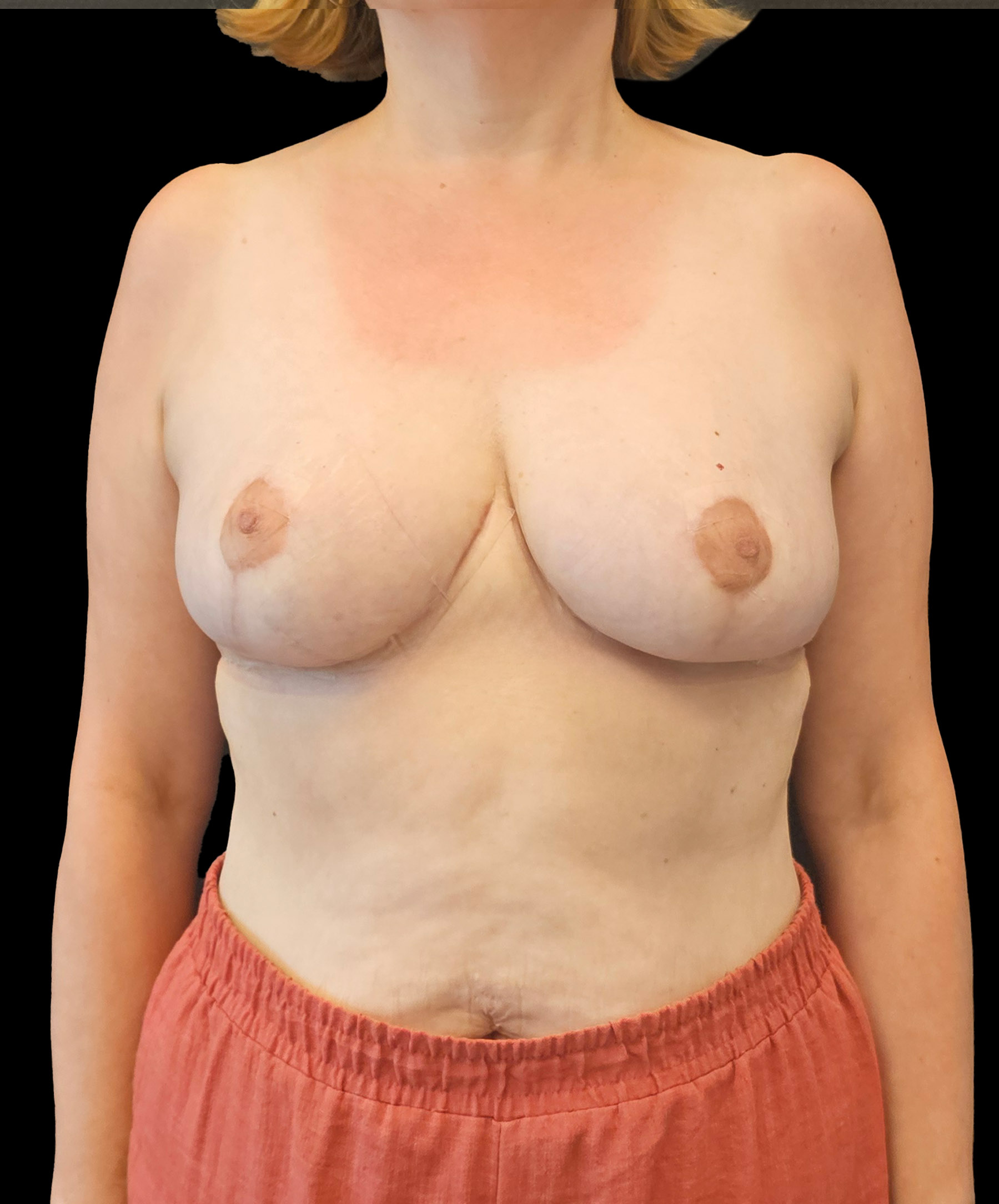 Odciążenie pleców po zmniejszeniu piersi wykonanym przez dr Kołacza we Wrocławiu