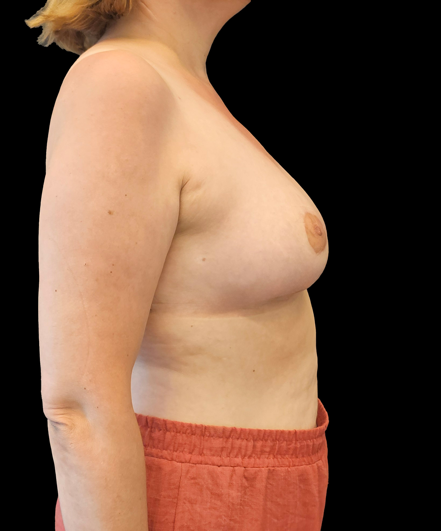 Symetria piersi po zmniejszeniu chirurgicznym dr Kołacz Wrocław