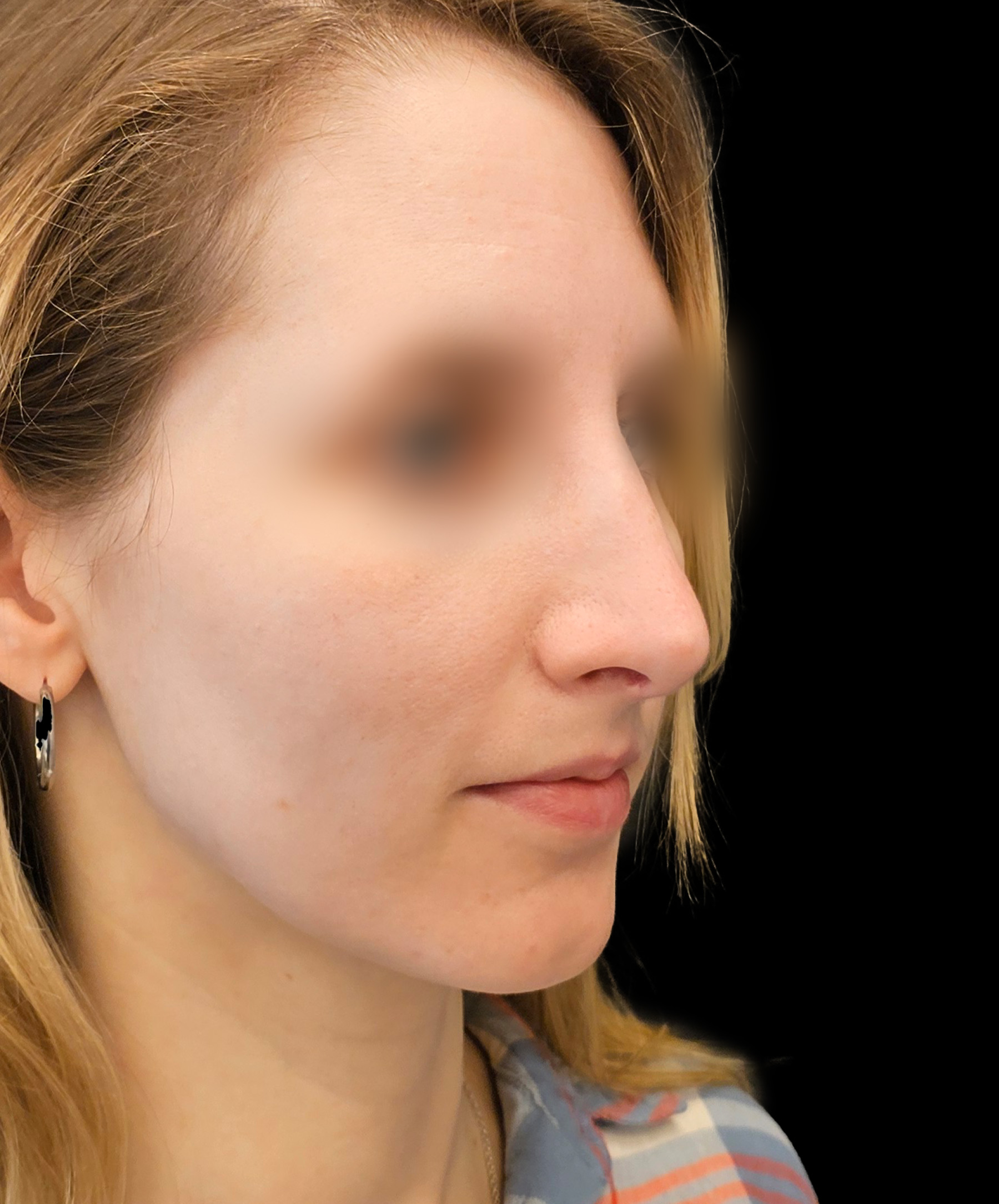 Czubek nosa po plastyce nosa wykonanej przez dr Kołacza we Wrocławiu