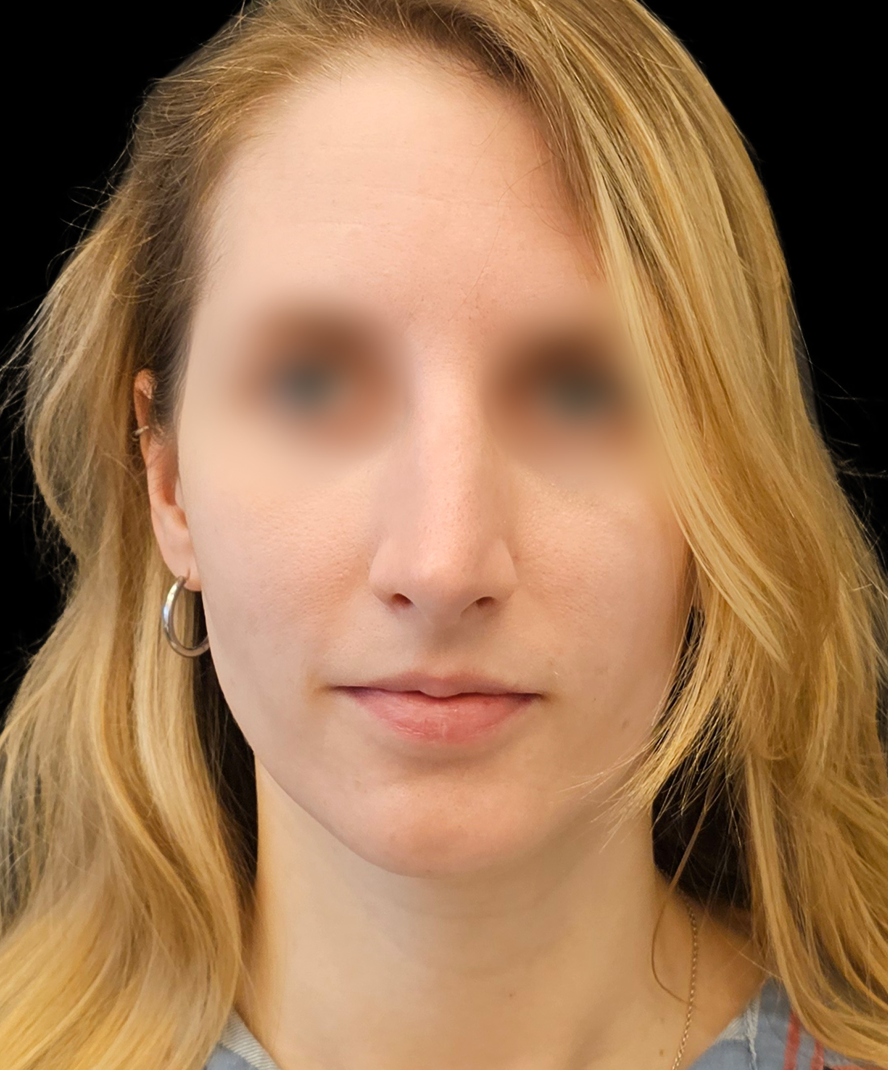 Plastyka nosa Wrocław