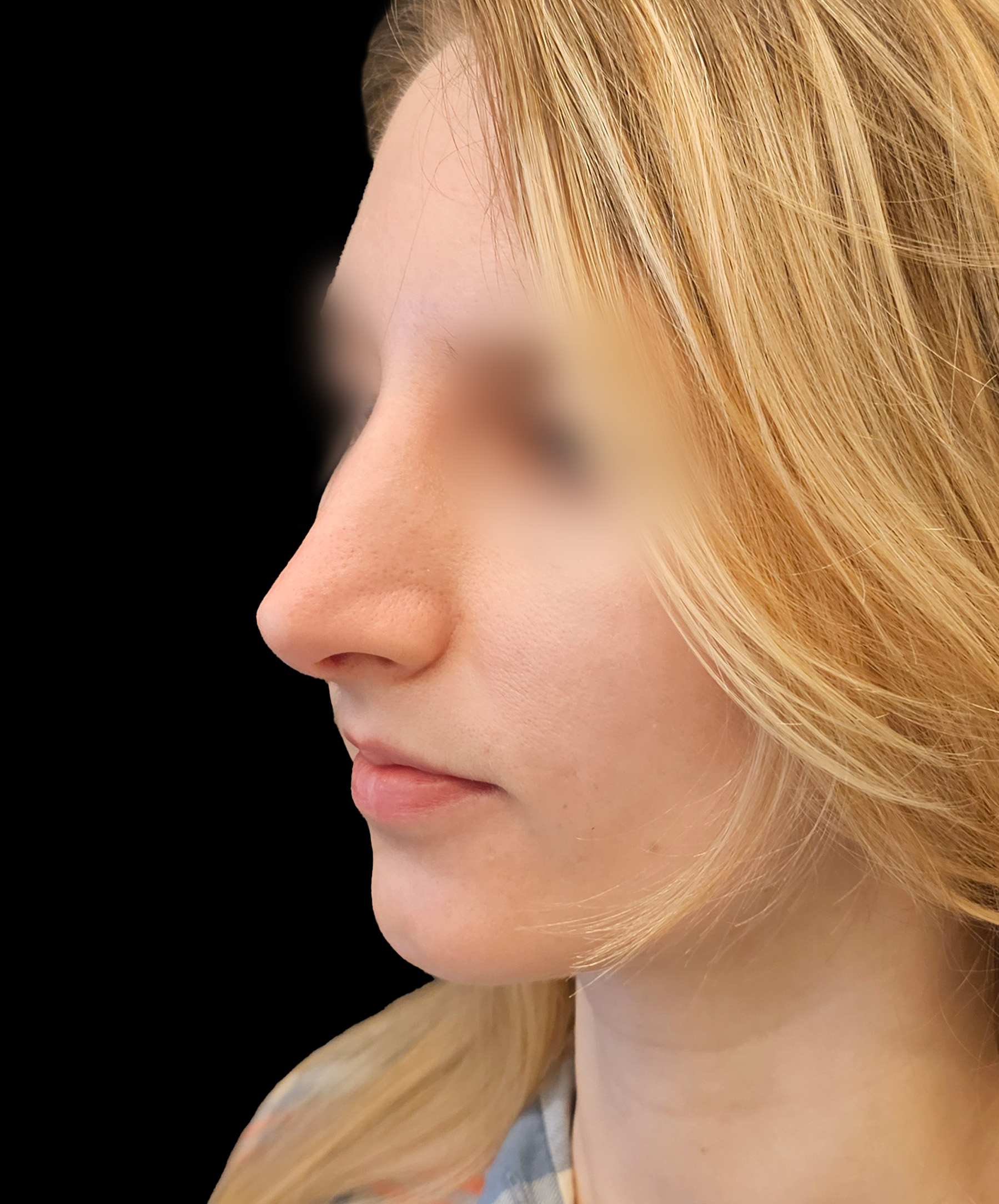 Proporcje twarzy po plastyce nosa dr Kołacz Wrocław