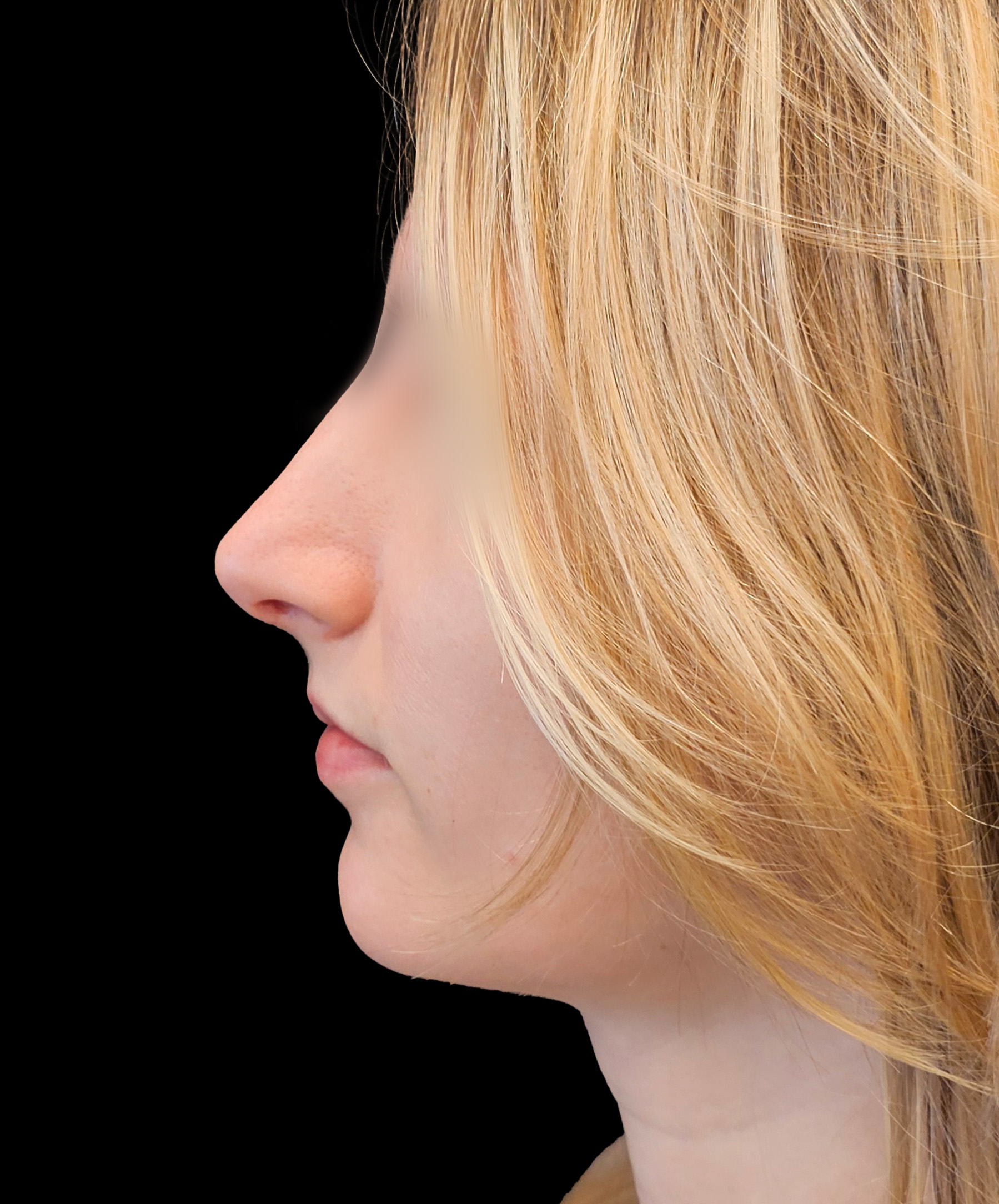 Symetria nosa po plastyce chirurgicznej dr Kołacz Wrocław