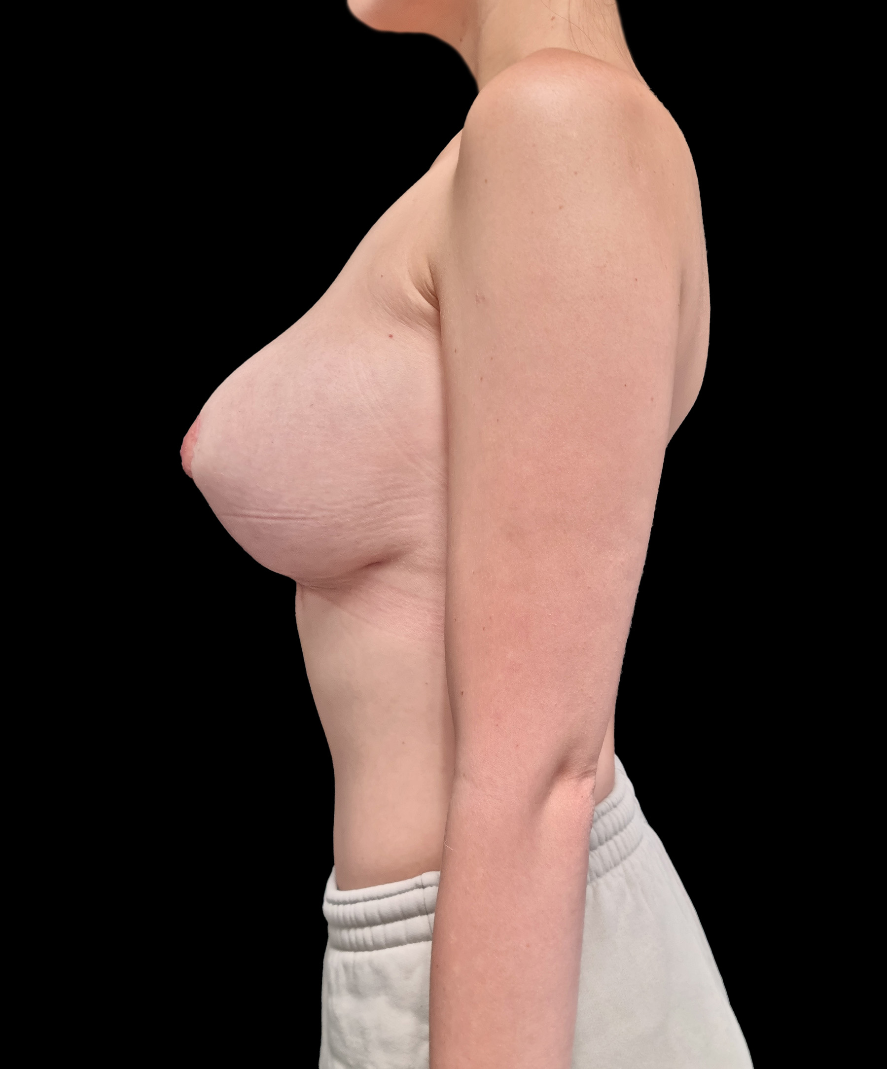 Zmniejszenie biustu Wrocław Naturalny kształt piersi po redukcji wykonanej przez dr Kołacza we Wrocławiu